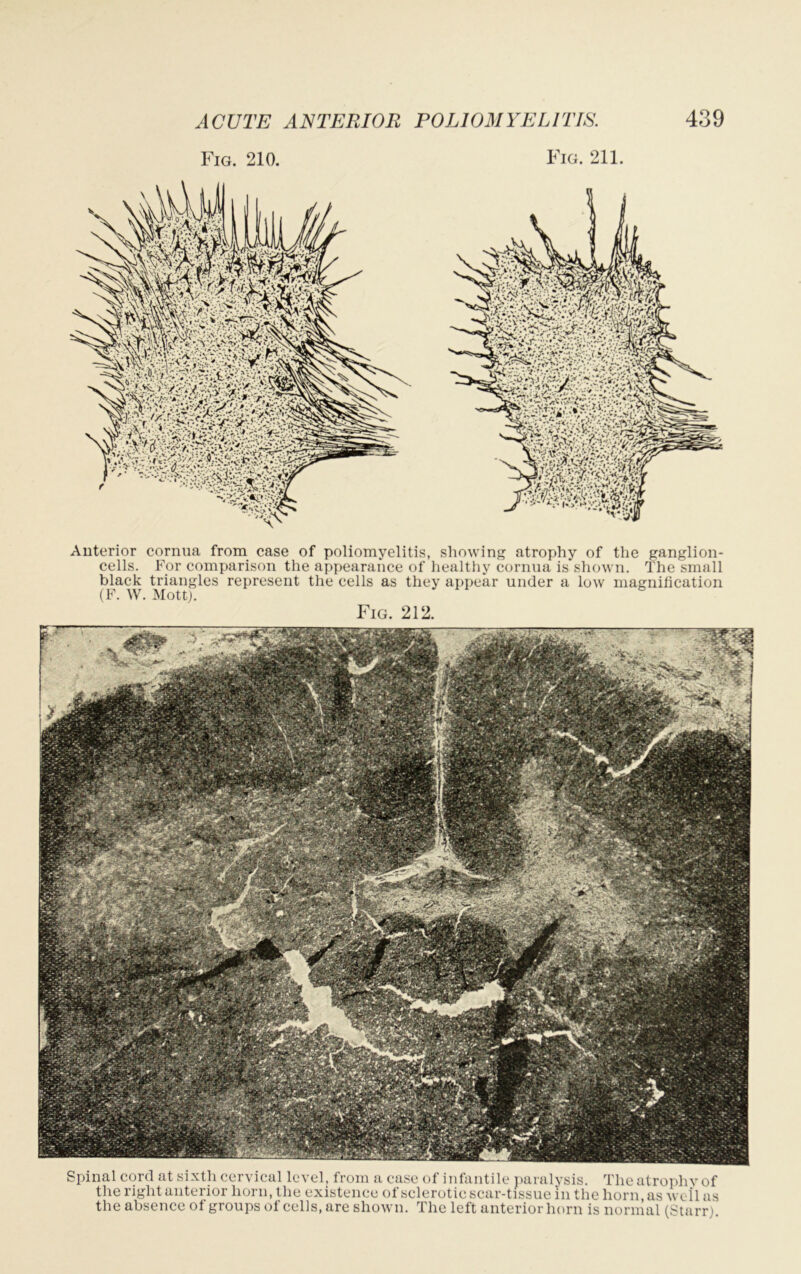 Fig. 210. Fig. 211. Anterior cornua from case of poliomyelitis, showing atrophy of the ganglion- cells. For comparison the appearance of healthy cornua is shown. The small black triangles represent the cells as they appear under a low magnification (F. W. Mott). Fig. 212. Spinal cord at sixth cervical level, from a case of infantile paralysis. Theatrophvof the right anterior horn, the existence of sclerotic scar-tissue in the horn, as well as the absence of groups of cells, are shown. The left anterior horn is normal (Starr).