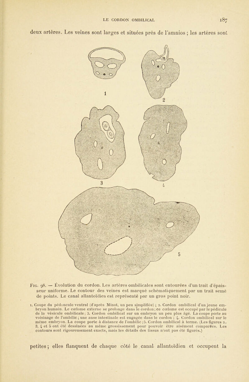 iWÆ îÊ^mm -«A»>M: ' fl / /-K.-W -1 lÉ^*-%isj \-&yï'^k :^>5^>W''‘;V’:;.'.':* r*^ô-iNVi'’.‘/i^' Vjo^.vt'/ ’»^»;' ''. î9ÿS;ÿ^&î«:,f#;JSé>ïï^#^ sp*»«8S#»«^siillfl®iîsi ilï*iiiiallip|l*iS^ \ ,X'C ; '-V V*’»“Jy-A^i?i*-^î'' •'•”?■-• ^ I ' '^•vr-v^^i'-T-. •• 'i'•'Tir^*'’,,'» •*' .^ S AJS. - deux artères. Les veines sont larges et situées près de Lamnios ; les artères sont Fig. 98. — Évolution du cordon. Les artères ombilicales sont entourées d’un trait d’épais- seur uniforme. Le contour des veines est marqué schématiquement par un trait semé de points. Le canal allantoïdien est représenté par un gros point noir. 1. Coupe du pédoncule ventral (d’après Minot, un peu simplifiée) ; 2. Cordon ombilical d’un jeune em- bryon humain. Le cœlome externe se prolonge dansîe cordon; ce cœlome est occupé par le pédicule de la vésicule ombilicale; 3. Cordon ombilical sur un embryon un peu plus âgé. La coupe porte au voisinage de l’ombilic ; une anse intestinale est engagée dans le cordon ; 4. Cordon ombilical sur le même embryon. La coupe porte à distance de l’ombilic ;5. Cordon ombilical à terme. (Les figures 2, 3, 4 et 5 ont été dessinées au même grossissement pour pouvoir être aisément comparées. Les contours sont rigoureusement exacts, mais les détails des tissus n’ont pas été figurés.) petites ; elles flanquent de chaque côté le canal allantoïdien et occupent la