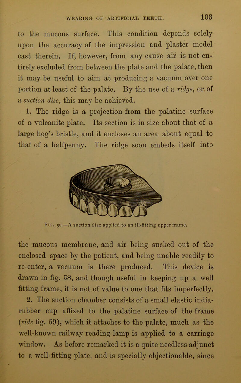 to the mucous surface. This condition depends solely upon the accuracy of the impression and plaster model cast therein. If, however, from any cause air is not en- tirely excluded from between the plate and the palate, then it may be useful to aim at producing a vacuum over one portion at least of the palate. By the use of a ridge, or of a suction disc, this may be achieved. 1. The ridge is a projection from the palatine surface of a vulcanite plate. Its section is in size about that of a large hog’s bristle, and it encloses an area about equal to that of a halfpenny. The ridge soon embeds itself into F;g. 59.—A suction disc applied to an ill-fitting upper frame. the mucous membrane, and air being sucked out of the enclosed space by the patient, and being unable readily to re-enter, a vacuum is there produced. This device is drawn in fig. 58, and though useful in keeping up a well fitting frame, it is not of value to one that fits imperfectly. 2. The suction chamber consists of a small elastic india- rubber cup affixed to the palatine surface of the frame (vide fig. 59), which it attaches to the palate, much as the well-known railway reading lamp is applied to a carriage window. As before remarked it is a quite needless adjunct to a well-fitting plate, and is specially objectionable, since