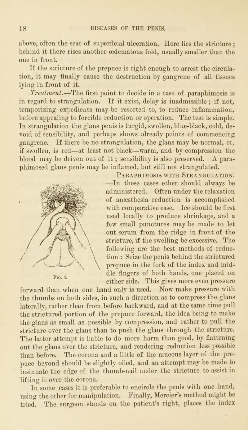 above, often the seat of superficial ulceration. Here lies the stricture ; behind it there rises another oedematous fold, usually smaller than the one in front. If the stricture of the prepuce is tight enough to arrest the circula- tion, it may finally cause the destruction by gangrene of all tissues lying in front of it. Treatment.—The first point to decide in a case of paraphimosis is in regard to strangulation. If it exist, delay is inadmissible ; if not, temporizing expedients may be resorted to, to reduce inflammation, before appealing to forcible reduction or operation. The test is simple. In strangulation the glans penis is turgid, swollen, blue-black, cold, de- void of sensibility, and perhaps shows already points of commencing gangrene. If there be no strangulation, the glans may be normal, or, if swollen, is red—at least not black—warm, and by compression the blood may be driven out of it ; sensibility is also preserved. A para- phimosed glans penis may be inflamed, but still not strangulated. Paraphimosis with Strangulation. —In these cases ether should always be administered. Often under the relaxation of anaesthesia reduction is accomplished with comparative ease. Ice should be first used locally to produce shrinkage, and a few small punctures may be made to let out serum from the ridge in front of the stricture, if the swelling be excessive. The following are the best methods of reduc- tion : Seize the penis behind the strictured prepuce in the fork of the index and mid- dle fingers of both hands, one placed on either side. This gives more even pressure forward than when one hand only is used. How make pressure with the thumbs on both sides, in such a direction as to compress the glans laterally, rather than from before backward, and at the same time pull the strictured portion of the prepuce forward, the idea being to make the glans as small as possible by compression, and rather to pull the stricture over the glans than to push the glans through the stricture. The latter attempt is liable to do more harm than good, by flattening out the glans over the stricture, and rendering reduction less possible than before. The corona and a little of the mucous layer of the pre- puce beyond should be slightly oiled, and an attempt may be made to insinuate the edge of the thumb-nail under the stricture to assist in lifting it over the corona. In some cases it is preferable to encircle the penis with one hand, using the other for manipulation. Finally, Mercier’s method might be tried. The surgeon stands on the patient’s right, places the index