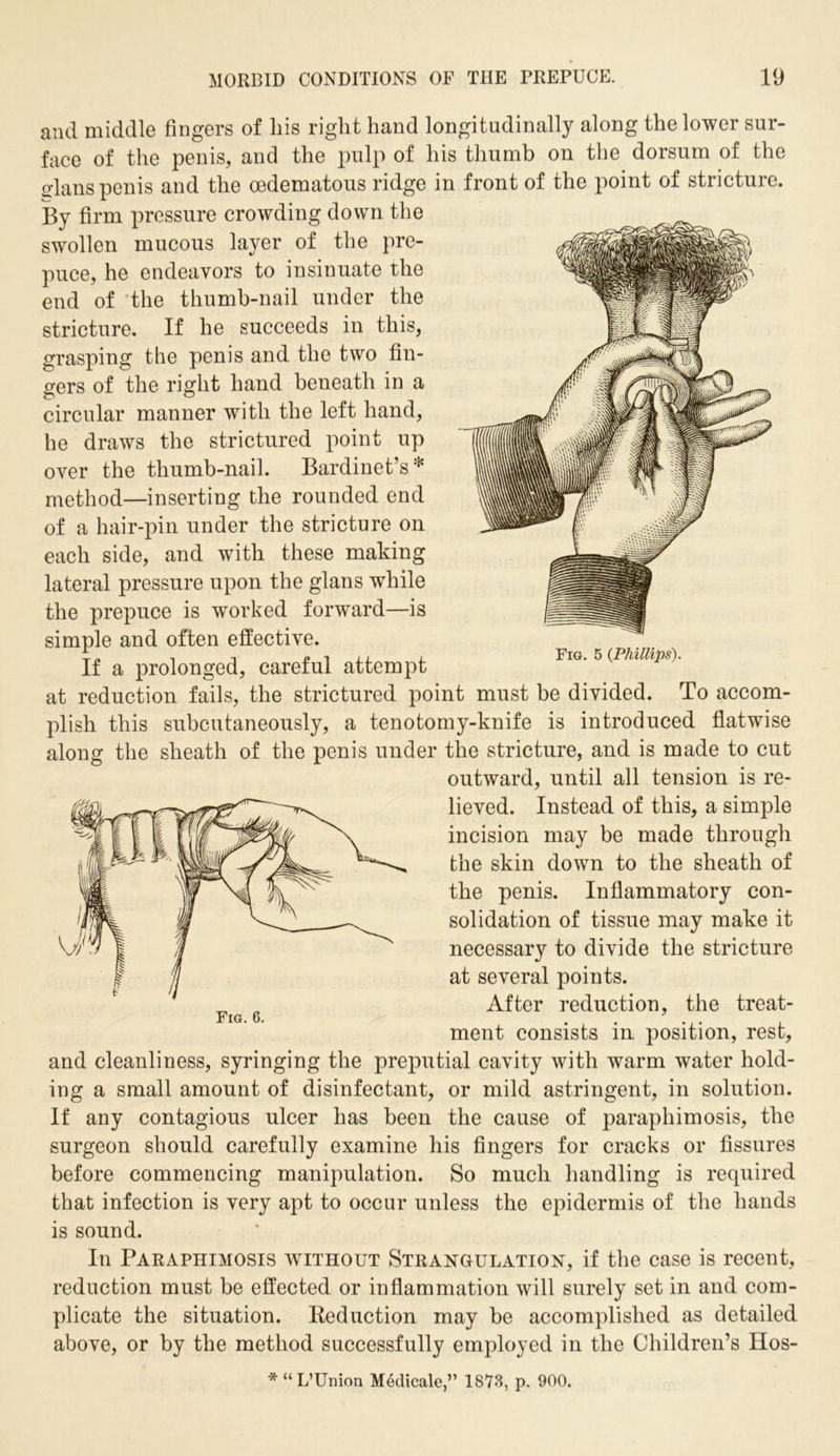 Fig. 5 {Phillips). and middle fingers of liis right hand longitudinally along the lower sur- face of the penis, and the pulp of his thumb on the dorsum of the glans penis and the oedematous ridge in front of the point of stricture. By firm pressure crowding down the swollen mucous layer of the pre- puce, he endeavors to insinuate the end of the thumb-nail under the stricture. If he succeeds in this, grasping the penis and the two fin- gers of the right hand beneath in a circular manner with the left hand, he draws the strictured point up over the thumb-nail. Bardinet’s* method—inserting the rounded end of a hair-pin under the stricture on each side, and with these making lateral pressure upon the glans while the prepuce is worked forward—is simple and often effective. If a prolonged, careful attempt at reduction fails, the strictured point must be divided. To accom- plish this subcutaneously, a tenotomy-knife is introduced flatwise along the sheath of the penis under the stricture, and is made to cut outward, until all tension is re- lieved. Instead of this, a simple incision may be made through the skin down to the sheath of the penis. Inflammatory con- solidation of tissue may make it necessary to divide the stricture at several points. After reduction, the treat- ment consists in position, rest, and cleanliness, syringing the preputial cavity with warm water hold- ing a small amount of disinfectant, or mild astringent, in solution. If any contagious ulcer has been the cause of paraphimosis, the surgeon should carefully examine his fingers for cracks or fissures before commencing manipulation. So much handling is required that infection is very apt to occur unless the epidermis of the hands is sound. In Paraphimosis without Strangulation, if the case is recent, reduction must be effected or inflammation will surely set in and com- plicate the situation. Reduction may be accomplished as detailed above, or by the method successfully employed in the Children’s Hos- * “L’Union Medicale,” 1873, p. 900.
