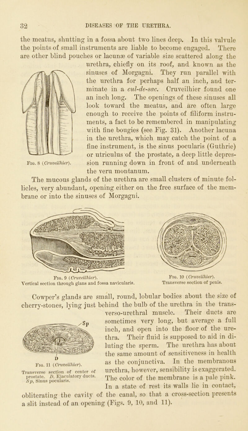 the meatus, shutting in a fossa about two lines deep. In this valvule the points of small instruments are liable to become engaged. There are other blind pouches or lacunae of variable size scattered along the urethra, chiefly on its roof, and known as the sinuses of Morgagni. They run parallel with the urethra for perhaps half an inch, and ter- minate in a cul-de-sac. Cruveilhier found one an inch long. The openings of these sinuses all look toward the meatus, and are often large enough to receive the points of filiform instru- ments, a fact to be remembered in manipulating with fine bougies (see Fig. 31). Another lacuna in the urethra, which may catch the point of a fine instrument, is the sinus pocularis (Guthrie) or utriculus of the prostate, a deep little depres- Fig. 8 {Cruveilhier). sion running down in front of and underneath the veru montanum. The mucous glands of the urethra are small clusters of minute fol- licles, very abundant, opening either on the free surface of the mem- brane or into the sinuses of Morgagni. Fig. 9 (Cruveilhier). Vertical section through glans and fossa navicularis. Fig. 10 (Cruveilhier). Transverse section of penis. Oowper’s glands are small, round, lobular bodies about the size of cherry-stones, lying just behind the bulb of the urethra in the trans- verso-uretliral muscle. Their ducts are sometimes very long, but average a full inch, and open into the floor of the ure- thra. Their fluid is supposed to aid in di- luting the sperm. The urethra has about the same amount of sensitiveness in health as the conjunctiva. In the membranous urethra, however, sensibility is exaggerated. The color of the membrane is a pale pink. In a state of rest its walls lie in contact, obliterating the cavity of the canal, so that a cross-section presents a slit instead of an opening (Figs. 9, 10, and 11). Fig. 11 (Cruveilhier). Transverse section of center of prostate. D, Ejaculatory ducts. Sp, Sinus pocularis.
