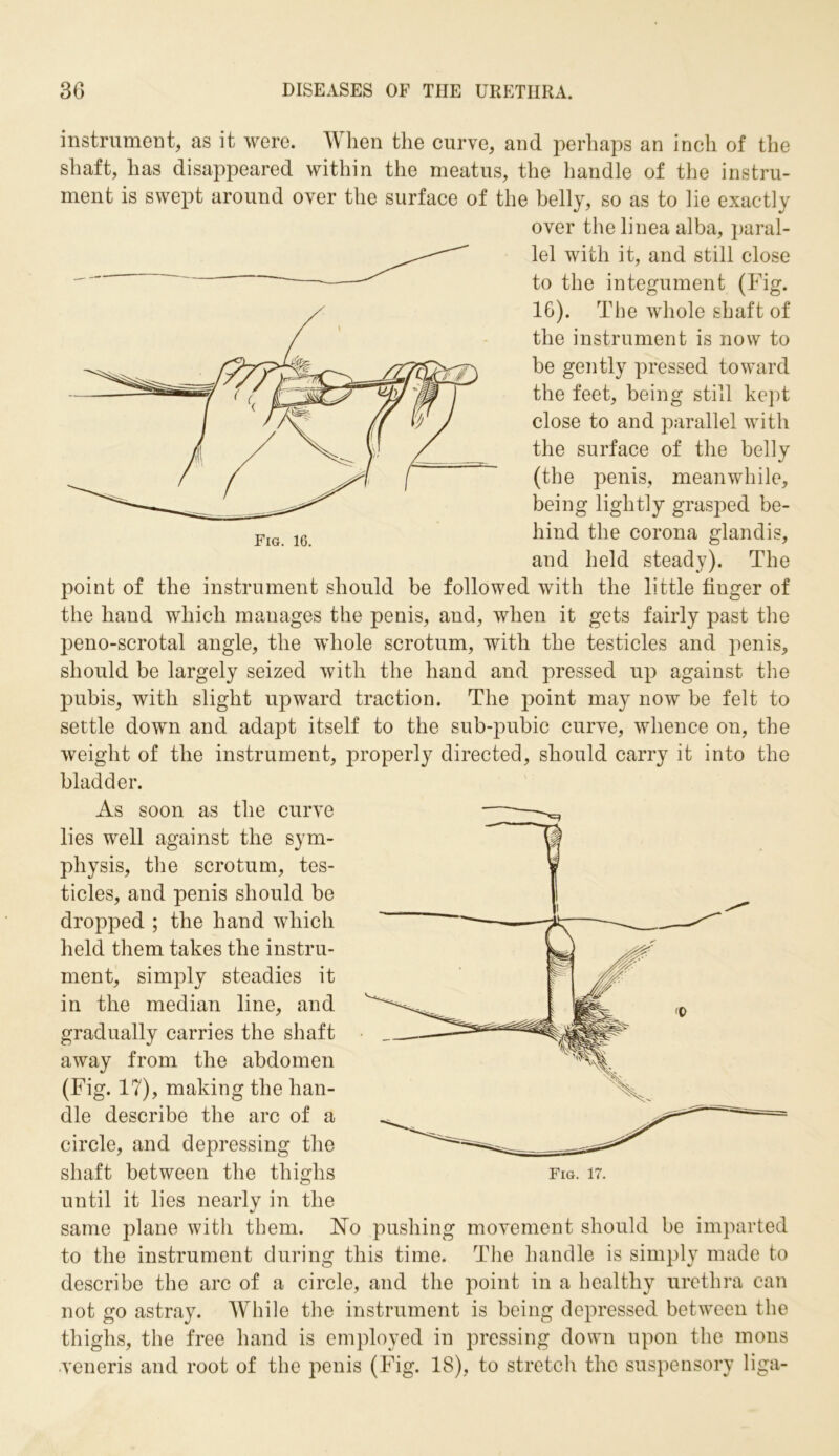 instrument, as it were. When the curve, and perhaps an inch of the shaft, has disappeared within the meatus, the handle of the instru- ment is swept around over the surface of the belly, so as to lie exactly over the linea alba, paral- lel with it, and still close to the integument (Fig. 16). The whole shaft of the instrument is now to be gently pressed toward the feet, being still kept close to and parallel with the surface of the belly (the penis, meanwhile, being lightly grasped be- hind the corona glandis, and held steady). The point of the instrument should be followed with the little finger of the hand which manages the penis, and, when it gets fairly past the peno-scrotal angle, the whole scrotum, with the testicles and penis, should be largely seized with the hand and pressed up against the pubis, with slight upward traction. The point may now be felt to settle down and adapt itself to the sub-pubic curve, whence on, the weight of the instrument, properly directed, should carry it into the bladder. As soon as the curve lies well against the sym- physis, the scrotum, tes- ticles, and penis should be dropped ; the hand which held them takes the instru- ment, simply steadies it in the median line, and gradually carries the shaft away from the abdomen (Fig. 17), making the han- dle describe the arc of a circle, and depressing the shaft between the thighs until it lies nearly in the same plane witli them. No pushing movement should be imparted to the instrument during this time. The handle is simply made to describe the arc of a circle, and the point in a healthy urethra can not go astray. While the instrument is being depressed between the thighs, the free hand is employed in pressing down upon the mons veneris and root of the penis (Fig. 18), to stretch the suspensory liga-