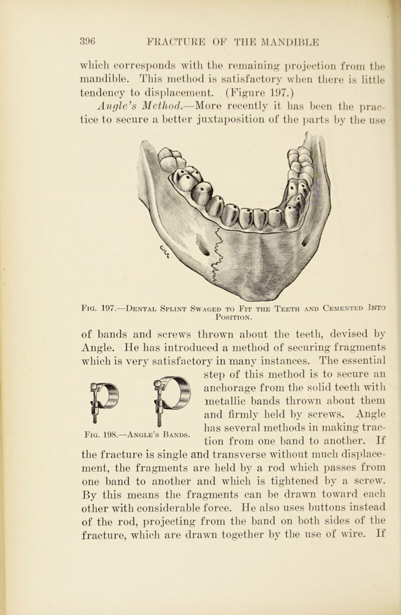 which corresponds witli the remaining1 projection from the mandible. This method is satisfactory when there is little tendency to displacement. (Figure 197.) Angle's Method.—More recently it lias been the prac- tice to secure a better juxtaposition of the parts by the use Fig. 197.—Dental Splint Swaged to Fit the Teeth and Cemented Into Position. of bands and screws thrown about the teeth, devised by Angle. He has introduced a method of securing fragments which is very satisfactory in many instances. The essential step of this method is to secure an anchorage from the solid teeth with metallic bands thrown about them and firmly held by screws. Angle , has several methods in making trac- Fig. 198.—Angle s Bands. ,. _ , , . ,, TJ? tion from one band to another, it the fracture is single and transverse without much displace- ment, the fragments are held by a rod which passes from one band to another and which is tightened by a screw. By this means the fragments can be drawn toward each other with considerable force. He also uses buttons instead of the rod, projecting from the band on both sides of the fracture, which are drawn together by the use of wire. If