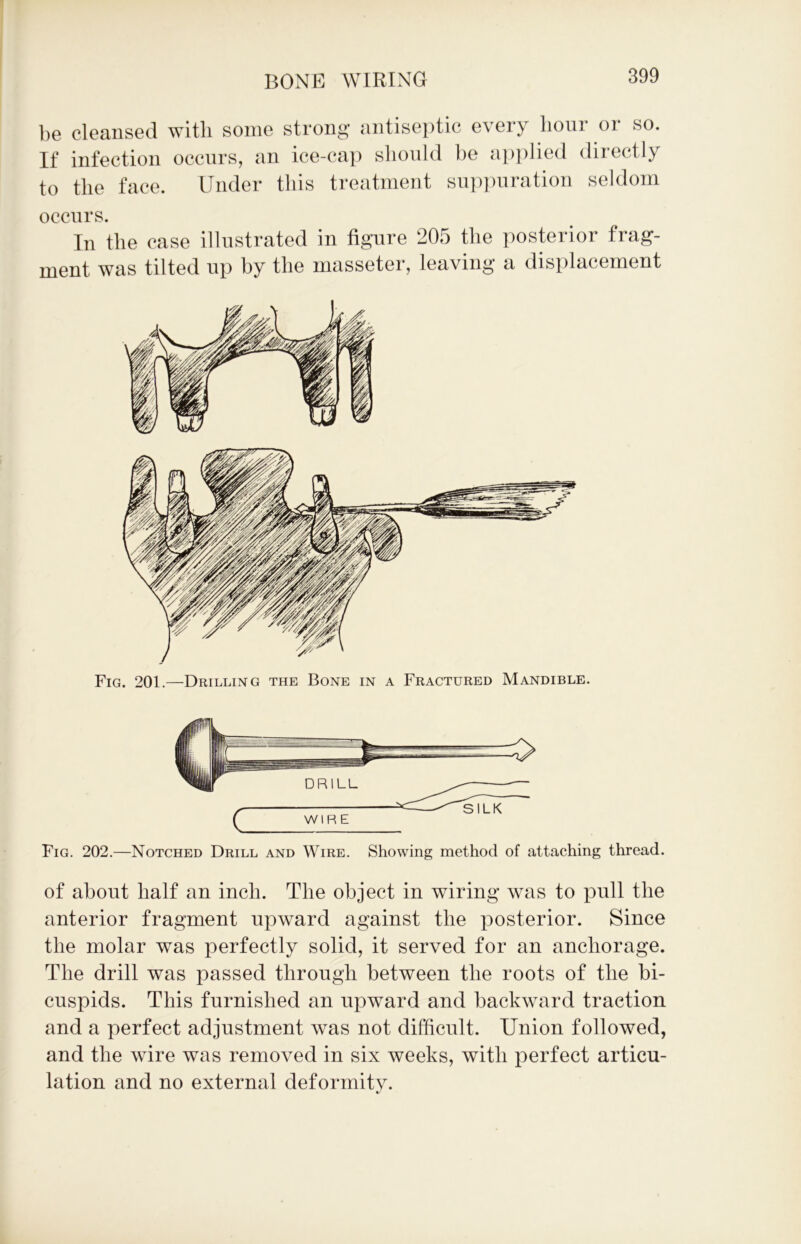 be cleansed with some strong antiseptic every hour or so. If infection occurs, an ice-cap should be applied directly to the face. Under this treatment suppuration seldom occurs. In the case illustrated in figure 205 the posterior frag- ment was tilted up by the masseter, leaving a displacement Fig. 202.—Notched Drill and Wire. Showing method of attaching thread. of about half an inch. The object in wiring was to pull the anterior fragment upward against the posterior. Since the molar was perfectly solid, it served for an anchorage. The drill was passed through between the roots of the bi- cuspids. This furnished an upward and backward traction and a perfect adjustment was not difficult. Union followed, and the wire was removed in six weeks, with perfect articu- lation and no external deformity.