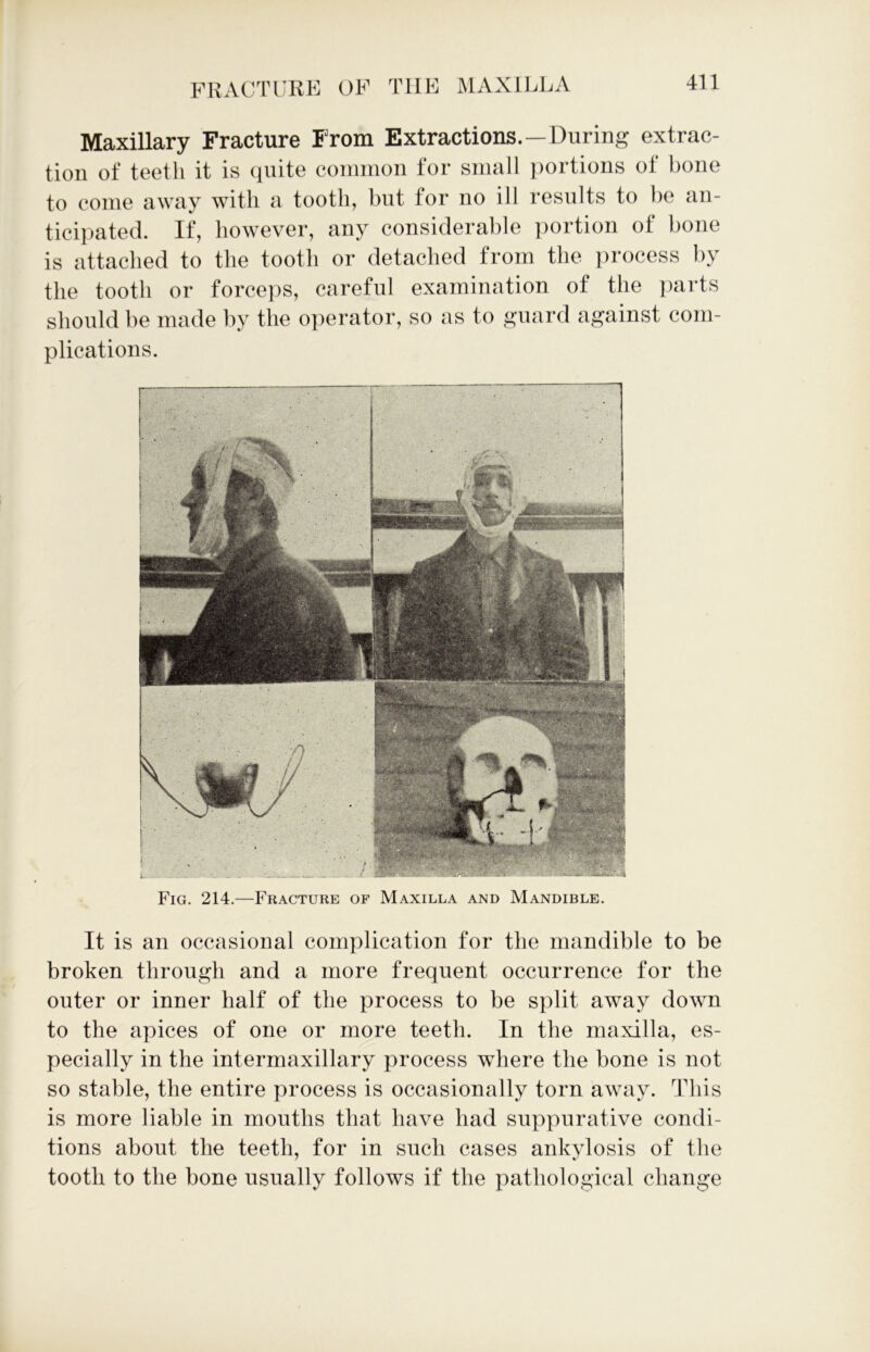 Maxillary Fracture From Extractions.—During extrac- tion of teeth it is quite common for small portions of bone to come away with a tooth, but for no ill results to be an- ticipated. If, however, any considerable portion of bone is attached to the tooth or detached from the process by the tooth or forceps, careful examination of the parts should be made by the operator, so as to guard against com- plications. Fig. 214.—Fracture of Maxilla and Mandible. It is an occasional complication for the mandible to be broken through and a more frequent occurrence for the outer or inner half of the process to be split away down to the apices of one or more teeth. In the maxilla, es- pecially in the intermaxillary process where the bone is not so stable, the entire process is occasionally torn away. This is more liable in mouths that have had suppurative condi- tions about the teeth, for in such cases ankylosis of the tooth to the bone usually follows if the pathological change