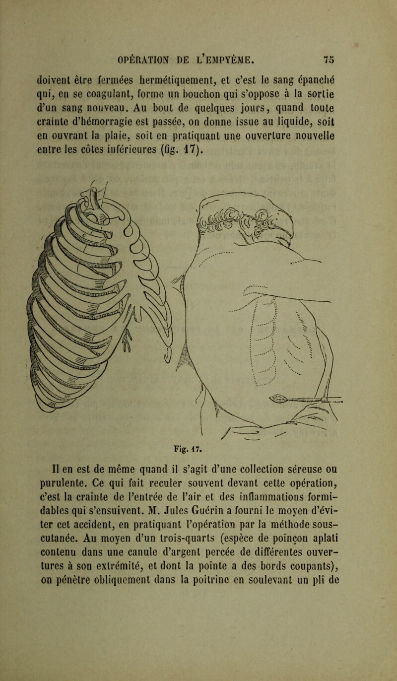 OPÉRATION DE l’EiMPYÈME. 7o doivent être fermées hermétiquement, et c’est le sang épanché qui, en se coagulant, forme un bouchon qui s’oppose à la sortie d’un sang nouveau. Au bout de quelques jours, quand toute crainte d’hémorragie est passée, on donne issue au liquide, soit en ouvrant la plaie, soit en pratiquant une ouverture nouvelle entre les côtes inférieures (fig. 17). Il en est de même quand il s’agit d’une collection séreuse ou purulente. Ce qui fait reculer souvent devant cette opération, c’est la crainte de l’entrée de l’air et des inflammations formi- dables qui s’ensuivent. M. Jules Guérin a fourni le moyen d’évi- ter cet accident, en pratiquant l’opération par la méthode sous- cutanée. Au moyen d’un trois-quarts (espèce de poinçon aplati contenu dans une canule d’argent percée de différentes ouver- tures à son extrémité, et dont la pointe a des bords coupants), on pénètre obliquement dans la poitrine en soulevant un pli de