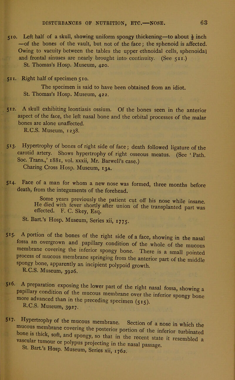 510. Left half of a skull, showing uniform spongy thickening—to about £ inch —of the bones of the vault, but not of the face; the sphenoid is affected. Owing to vacuity between the tables the upper ethnoidal cells, sphenoidal and frontal sinuses are nearly brought into continuity. (See 511.) St. Thomas’s Hosp. Museum, 420. 511. Right half of specimen 510. The specimen is said to have been obtained from an idiot. St. Thomas’s Hosp. Museum, 422. 512. A skull exhibiting leontiasis ossium. Of the bones seen in the anterior aspect of the face, the left nasal bone and the orbital processes of the malar bones are alone unaffected. R.C.S. Museum, 1238. 513. Hypertrophy of bones of right side of face; death followed ligature of the carotid artery. Shows hypertrophy of right osseous meatus. (See ‘ Path. Soc. Trans.,’ 1881, vol. xxxii, Mr. Barwell’s case.) Charing Cross Hosp. Museum, 13a. 514. Face of a man for whom a new nose was formed, three months before death, from the integuments of the forehead. Some years previously the patient cut off his nose while insane He died with fever shortly after union of the transplanted part was effected. F. C. Skey, Esq. St. Bart.’s Hosp. Museum, Series xii, 1775. 5i5- A portion of the bones of the right side of a face, showing in the nasal fossa an overgrown and papillary condition of the whole of the mucous membrane covering the inferior spongy bone. There is a small pointed process of mucous membrane springing from the anterior part of the middle spongy bone, apparently an incipient polypoid growth. R.C.S. Museum, 3926. 516. A preparation exposing the lower part of the right nasal fossa, showing a papillary condition of the mucous membrane over the inferior spongy bone more advanced than in the preceding specimen (515). R.C.S. Museum, 3927. 517- Hypertrophy of the mucous membrane. Section of a nose in which the bone0is thick softeaCn7ring ^ ^ P°rti°n °f the inferior Abated vascular turn’ ? Sp°ngy’ S° that m the recent state * resembled a scalar tumour or polypus projecting in the nasal passage. St. Bart, s Hosp. Museum, Series xii, 1762.