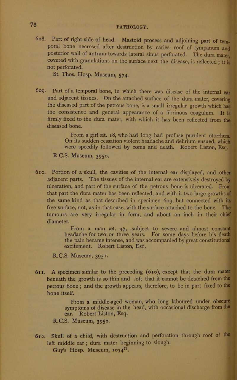 PATHOLOGY. 608. Part of right side of head. Mastoid process and adjoining part of tem- poral bone necrosed after destruction by caries, roof of tympanum and posterior wall of antrum towards lateral sinus perforated. The dura mater, covered with granulations on the surface next the disease, is reflected ; it is not perforated. St. Thos. Hosp. Museum, 574. 609. Part of a temporal bone, in which there was disease of the internal ear and adjacent tissues. On the attached surface of the dura mater, covering the diseased part of the petrous bone, is a small irregular growth which has the consistence and general appearance of a fibrinous coagulum. It is firmly fixed to the dura mater, with which it has been reflected from the diseased bone. From a girl get. 18, who had long had profuse purulent otorrhcea. On its sudden cessation violent headache and delirium ensued, which were speedily followed by coma and death. Robert Liston, Esq. R.C.S. Museum, 3950. 610. Portion of a skull, the cavities of the internal ear displayed, and other adjacent parts. The tissues of the internal ear are extensively destroyed by ulceration, and part of the surface of the petrous bone is ulcerated. From that part the dura mater has been reflected, and with it two large growths of the same kind as that described in specimen 609, but connected with its free surface, not, as in that case, with the surface attached to the bone. The tumours are very irregular in form, and about an inch in their chief diameter. From a man get. 47, subject to severe and almost constant headache for two or three years. For some days before his death the pain became intense, and was accompanied by great constitutional excitement. Robert Liston, Esq. R.C.S. Museum, 3951. 611. A specimen similar to the preceding (610), except that the dura mater beneath the growth is so thin and soft that it cannot be detached from the petrous bone : and the growth appears, therefore, to be in part fixed to the bone itself. From a middle-aged woman, who long laboured under obscure symptoms of disease in the head, with occasional discharge from the ear. Robert Liston, Esq. R.C.S. Museum, 3952. 612. Skull of a child, with destruction and perforation through roof of the left middle ear; dura mater beginning to slough. Guy’s Hosp. Museum, io74T5.