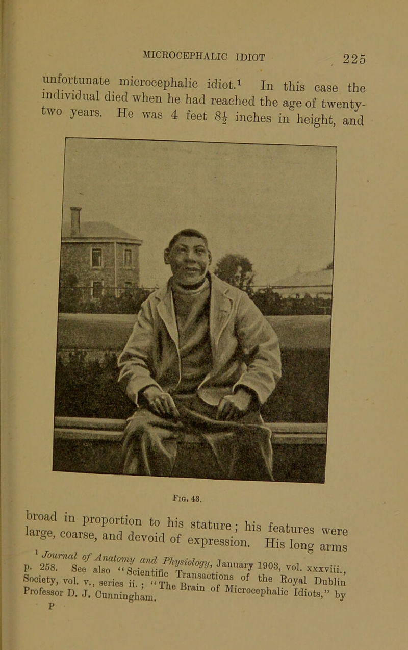 unfortunate microcephalic idiot.i In this case the individual died when he had reached the age of twenty- wo years. He was 4 feet SJ inches in height, and Profe.ssor D. J. Cunninghm Microcephalic Idiots,” by P