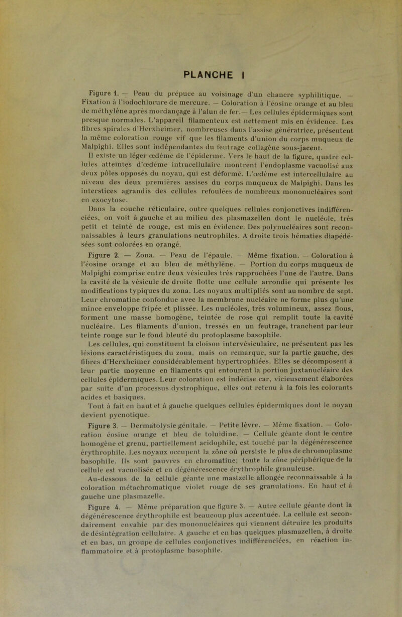 PLANCHE I Figure 1. — Peau du prépuce au voisinage d’un chancre syphilitique. — Fixation à riodochiorure de mercure. - Coloration à i éosine orange et au bleu de méthylène après mordançage à l’alun de fer.— Les cellules épidermiques sont presque normales. L’appareil filamenteux est nettement mis en évidence. Les fibres spirales d'Hei’xheimer. nombreuses dans l’assise génératrice, présentent ia même coloration rouge vif que ies filaments d’union du corps muqueux de Malpighi. Elles sont indépendantes du feutrage collagène sous-jacenf. Il existe un léger (tdème de l’épiderme. Vers le haut de la figure, quatre cel- lules atteintes d’a'dème intraceiiulairc montrent l’endoplasme vacuolisé aux deux pôles opposés du noyau, qui est déformé. L’iedème est intercellulaire au niveau des deux premières assises du corps muqueux de Malpighi. Dans les interstices agrandis des cellules refoulées de nombreux mononucléaires sont en exocytose. Dans la couche réticulaire, outre quelques cellules conjonctives indifféren- ciées, on voit à gauche et au milieu des plasmazellen dont le nucléole, très petit et teinté de rouge, est mis en évidence. Des polynucléaires sont recon- naissables à leurs granulations neutrophiles. A droite trois hématies diapédé- sées sont colorées en orangé. Figure 2. — Zona. — Peau de l’épaule. — Même fixation. — Coloration à l’éosine orange et au bleu de méth^dène. — Portion du corps muqueux de •Malpighi comprise entre deux vésicules très rapprochées l’une de l’autre. Dans la cavité de la vésicule de droite flotte une cellule arrondie qui présente les modifications typiques du zona. Les noyaux multipliés sont au nombre de sept. Leur chromatine confondue avec la membrane nucléaire ne forme plus qu'une mince enveloppe fripée et plissée. Les nucléoles, très volumineux, assez flous, forment une masse homogène, teintée de rose qui remplit toute la cavité nucléaire. Les filaments d’union, tressés en un feutrage, tranchent par leur teinte rouge sur le fond bleuté du protoplasme basophile. Les cellules, qui constituent la cloison intervésiculaire, ne présentent pas les lésions caractéristiques du zona, mais on remarque, sur la partie gauche, des fibres d’Herxheimer considérablement In'pertrophiées. Elles se décomposent A leur partie moyenne en filaments qui entourent la portion juxtanucléaire des cellules épidermiques. Leui- coloration est indécise car, vicieusement élaborées par suite d’un processus dystrophique, elles ont retenu à la fois les colorants acides et basiques. Tout à fait en haut et à gauche quelques cellules épidermiciues dont le noyau devient pyenotique. Figure 3. — Dermatolysie génitale. — Petite lèvre. .Même fixation. — Colo- ration éosine orange et bleu de toluidine. — Cellule géante dont le centre homogène et grenu, partiellement acidophile, est touché par la dégénérescence érythrophile. Les noyaux occupent la zone où persiste le plus de chroinoplasme basophile. Ils sont pauvres en chromatine; toute la zone péripliérique de la cellule est vacuolisée et en dégénérescence érythrophile granuleuse. Au-dessous de la cellule géante une mastzelle allongée reconnaissable a la coloration métachromati(|iie violet rouge de ses granulations. En haut et a gauche une plasmazelle. Figure 4. — .Même préparation (|ue figure 3. — .Autre cellule géante dont la dégénérescence érythro|)hile est beaucoup plus accentuée. La cellule est secon- dairement envahie pai' des mononucléaires qui viennent détruire les produits de désintégration cellulaire. A gauche et en bas quelques plasmazellen, à droite et en bas, un groupe de cellules conjonctives indifférenciées, en i-éaction in- Hammatoire et à protoplasme basophile.