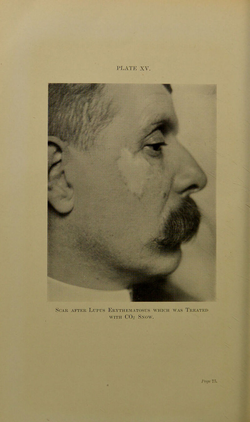 PLA'I’K XV Scar after Lupus Erythebiatosus which was Treated WITH CO2 Snow. J’oiie '