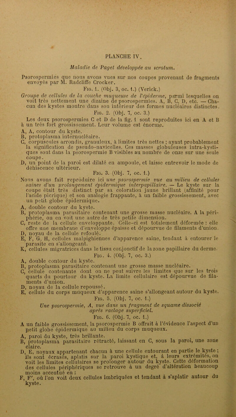 Maladie de Paget développée au tcrolum. Psorospermies que nous avons vues sur nos coupes provenant de fragments envoyés par M. RadclilTe Crocker. Fig. 1. (Obj. 3, oc. 1.) (Verick.) Groupe de cellules de la couche muqueuse de Vépiderme, parmi lesquelles on voit très nettement une dizaine de psorospermies. A, B, C, D, etc. — Cha- cun des kystes montre dans son intérieur des formes nucléaires distinctes. Fio. 2. (Obj. 7, oc. 3.) Les deux psorospermies C et D de la flg. 1 sont reproduites ici en A et B à un très fort grossissement. Leur volume est énorme. A, A, contour du kyste. B, protoplasma iuternucléaire. C, corpuscules arrondis, granuleux, à limites très nettes ; ayant probablement la signification de pseudo-navicelles. Ces masses globuleuses intra-kysti- ques sont dans la psorospermie B visibles au nombre de onze sur une seule coupe. D, un point de la paroi est dilaté en ampoule, et laisse entrevoir le mode de déhiscence ultérieur. Fig. 3. (Obj. 7, oc. 1.) Nous avons fait reproduire ici une psorospermie vue au milieu de cellules saines d’un prolongement épidermique interpapillaire. — Le kyste sur la coupe était très distinct par sa coloration jaune brillant (affinité pour l’acide picrique) et son analogie frappante, à un faible grossissement, avec un petit globe épidermique. A, double contour du kyste. B, protoplasma parasitaire contenant une grosse masse nucléaire. A la péri- phérie, on en voit une autre de très petite dimension. C, reste de la cellule enveloppante. Celle-ci est totalement déformée: elle olfre une membrane d’enveloppe épaisse et dépourvue de filaments d’union. D, noyau de la cellule refoulé. E, F, G-, H, cellules malpighiennes d’apparence saine, tendant à entourer le parasite en s’allongeant. K, cellules migratrices dans le tissu conjonctif de la zone papillaire du derme. Fig. 4. (Obj. 7, oc. 3.) A, double contour du kyste. B, protoplasma parasitaire contenant une grosse masse nucléaire. C, cellule contenante dont on ne peut suivre les limites que sur les trois quarts du pourtour du kyste. La limite cellulaire est dépourvue de fila- ments d’union. D, noyau de la cellule repoussé. E, cellule du corps müqueux d’apparence saine s’allongeant autour du kyste. Fig. 5. (Obj. 7, oc. 1.) Une psorospermie, A, vue dans un fragment de squame dissocié après raclage superficiel. Fig. 6. (Obj. 7, oc. 1.) A un faible grossissement, la psorospermie B offrait à l’évidence l’aspect d’un petit globe épidermique au milieu du corps muqueux. A, paroi du kyste, très brillante. B, protoplasma parasitaire rétracté, laissant en C, sous la paroi, une zone claire. . , , D, E, noyaux appartenant chacun à une cellule entourant en partie le kyste ; ils sont écrasés, aplatis sur la paroi kystique et, à leurs extrémités, on voit les limites cellulaires se prolonger autour du kyste. Cette déformation des cellules périphériques se retrouve à un degré d’altération beaucoup moins accentué en : , , . - j F, F', où l’on voit deux cellules imbriquées et tendant à s aplatir autour du kyste.