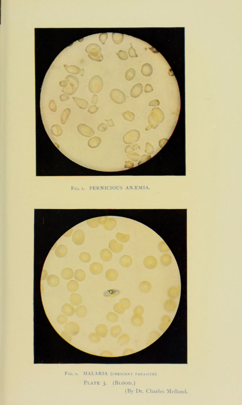 Fig. 2. (cresckn i' i’arasitk) I’l.ATE 3. (Hi.OOD.) (By Dr. Cliarks Melland.