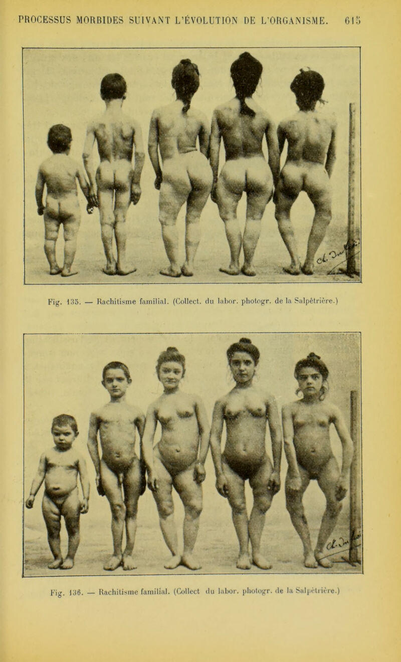 Fig. 135. — Rachitisme familial. (Collect. du Iabor. photogr. de la Salpêtrière.) Fig. 136. — Rachitisme familial. (Collect du Iabor. photogr. de la Salpêtrière.)