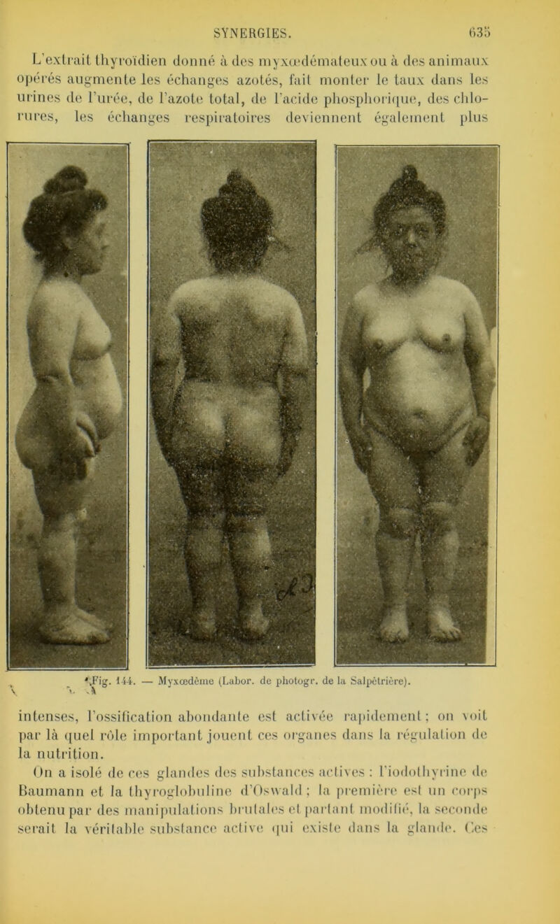 L’extrait thyroïdien donné à des myxœdémateuxou à des animaux opérés augmente les échanges azotés, fait monter le taux dans les urines de l’urée, de l’azote total, de l'acide phosphorique, des chlo- rures, les échanges respiratoires deviennent également plus '.Fig. 144. — Myx œdème (Labor. de photogr. de la Salpêtrière), v V - 4 intenses, l’ossification abondante est activée rapidement; on \oit par là quel rôle important jouent ces organes dans la régulation de la nutrition. On a isolé de ces glandes des substances actives : l’iodothyrine de Baumann et la thyroglobuline d’Oswald; la première est un corps obtenu par des manipulations brutales el partant modifié, la seconde serait la véritable substance active qui existe dans la glande. Ces