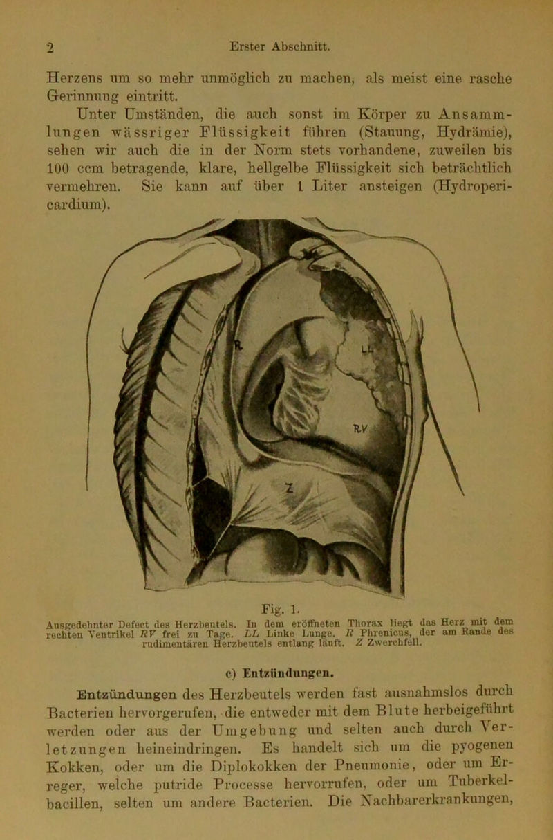 Herzens um so mehr unmöglich zu machen, als meist eine rasche Gerinnung eintritt. Unter Umständen, die auch sonst im Körper zu Ansamm- lungen wässriger Flüssigkeit führen (Stauung, Hydrämie), sehen wir auch die in der Norm stets vorhandene, zuweilen bis 100 ccm betragende, klare, hellgelbe Flüssigkeit sich beträchtlich vermehren. Sie kann auf über 1 Liter ansteigen (Hydroperi- cardium). Fig. 1. Ausgedehnter Defect des Herzbeutels. In dem eröffneten Thorax liegt das Herz mit dem rechten Ventrikel UV frei zu Tage. LL Linke Lunge. I? Phrenicus, der am Bande des rudimentären Herzbeutels entlang läuft. Z Zwerchfell. c) Entzündungen. Entzündungen des Herzbeutels werden fast ausnahmslos durch Bacterien hervorgerufen, die entweder mit dem Blute herbeigeführt werden oder aus der Umgebung und selten auch durch Ver- letzungen heineindringen. Es handelt sich um die pyogenen Kokken, oder um die Diplokokken der Pneumonie, oder um Er- reger, welche putride Processe hervorrufen, oder um Tuberkel- bacillen, selten um andere Bacterien. Die Nachbarerkrankungen,