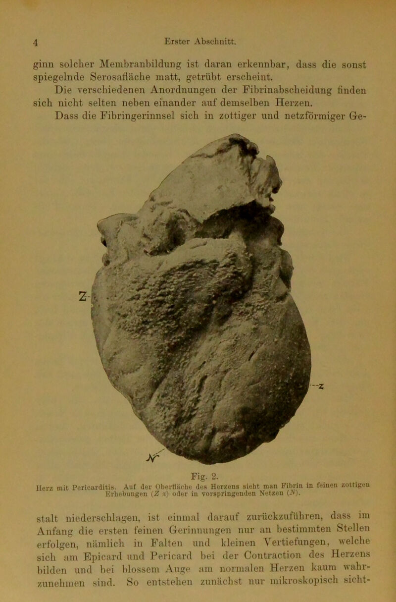 ginn solcher Membranbildung ist daran erkennbar, dass die sonst spiegelnde Serosafläche matt, getrübt erscheint. Die verschiedenen Anordnungen der Fibrinabscheidung linden sich nicht selten neben einander auf demselben Herzen. Dass die Fibringerinnsel sich in zottiger und netzförmiger Ge- Fig. 2. Herz mit Pericarditis. Auf der Oberfläche des Herzens sieht man Fibrin in feinen zottigen Erhebungen (Z x) oder in vorspringenden Netzen (A). stalt niederschlagen, ist einmal darauf zurückzuführen, dass im Anfang die ersten feinen Gerinnungen nur an bestimmten Stellen erfolgen, nämlich in Falten und kleinen Vertiefungen, welche sich am Epicard und Pericard bei der Contraction des Herzens bilden und bei blossem Auge am normalen Herzen kaum wahr- zunehmen sind. So entstehen zunächst nur mikroskopisch sicht-