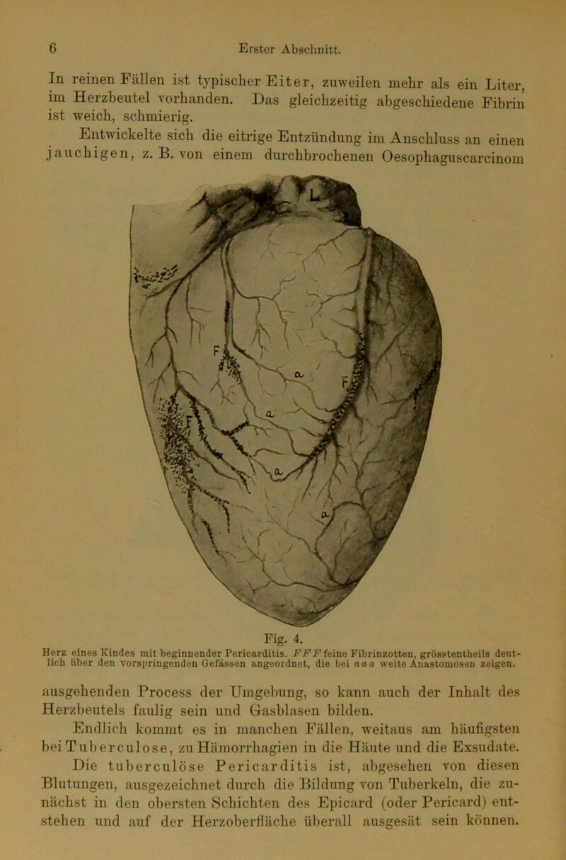 In reinen Fällen ist typischer Eiter, zuweilen mehr als ein Liter, im Herzbeutel vorhanden. Das gleichzeitig abgeschiedene Fibrin ist weich, schmierig. Entwickelte sich die eitrige Entzündung im Anschluss an einen jauchigen, z. B. von einem durchbrochenen Oesophaguscarcinom Fig. 4. Herz eines Kindes mit beginnender Pericarditis. FFF feine Fibrinzotten, grösstentheils deut- lich über den vorspriugendeu Gefässen ungeordnet, die bei aaa weite Anastomosen zeigen. ausgehenden Process der Umgehung, so kann auch der Inhalt des Herzbeutels faulig sein und Gasblasen bilden. Endlich kommt es in manchen Fällen, weitaus am häufigsten bei Tuberculose, zuHämorrhagien in die Häute und die Exsudate. Die tuberculose Pericarditis ist, abgesehen von diesen Blutungen, ausgezeichnet durch die Bildung von Tuberkeln, die zu- nächst in den obersten Schichten des Epicard (oder Pericard) ent- stehen und auf der Herzoberfläche überall ausgesät sein können.