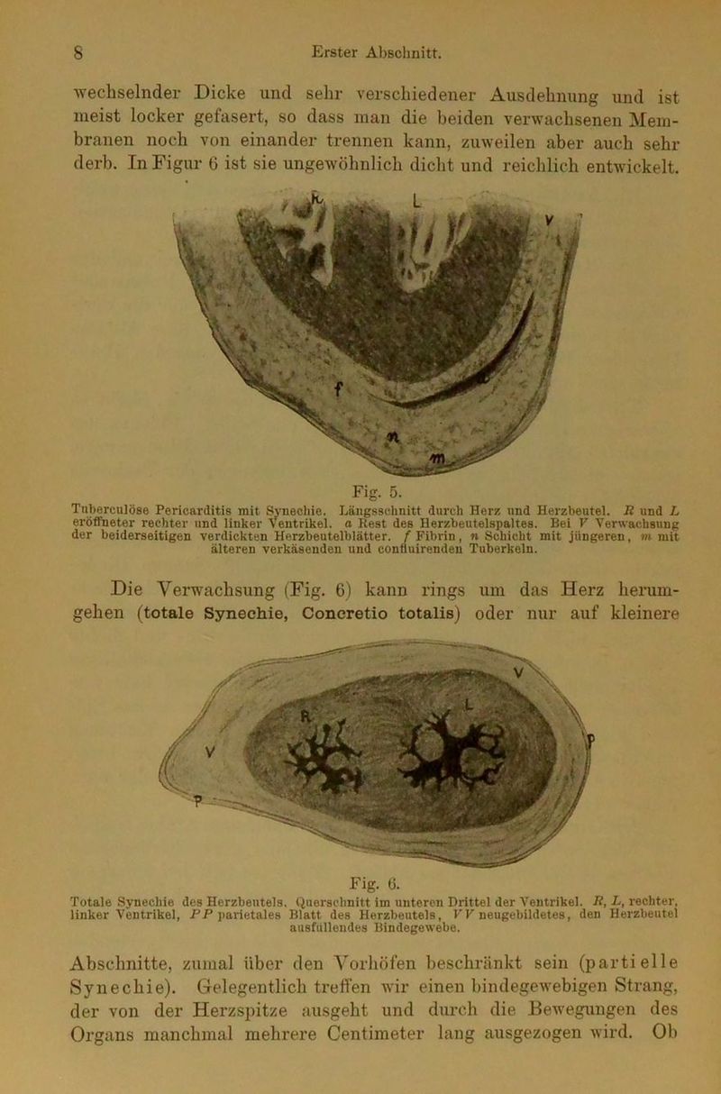 wechselnder Dicke und sehr verschiedener Ausdehnung und ist meist locker gefasert, so dass man die beiden verwachsenen Mem- branen noch von einander trennen kann, zuweilen aber auch sehr derb. In Figur 6 ist sie ungewöhnlich dicht und reichlich entwickelt. Fig. 5. Tuberculöse Pericarditis mit Synechie. Längsschnitt durch Herz und Herzbeutel. R und L eröffneter rechter und linker Ventrikel, a Rest des Herzbeutelspaltes. Bei V Verwachsung der beiderseitigen verdickten Herzbeutelblätter, f Fibi-in, n Schicht mit jüngeren, m mit älteren verkäsenden und conüuirenden Tuberkeln. Die Verwachsung (Fig. 6) kann rings um das Herz herum- gehen (totale Synechie, Concretio totalis) oder nur auf kleinere Fig. 6. Totale Synechie des Herzbeutels. Querschnitt im unteren Drittel der Ventrikel. R, L, rechter, linker Ventrikel, PP parietales Blatt des Herzbeutels, FF neugebildetes, den Herzbeutel ausfallendes Bindegewebe. Abschnitte, zumal über den Vorhöfen beschränkt sein (partielle Synechie). Gelegentlich treffen wir einen bindegewebigen Strang, der von der Herzspitze ausgeht und durch die Bewegungen des Organs manchmal mehrere Centimeter lang ausgezogen wird. Ob