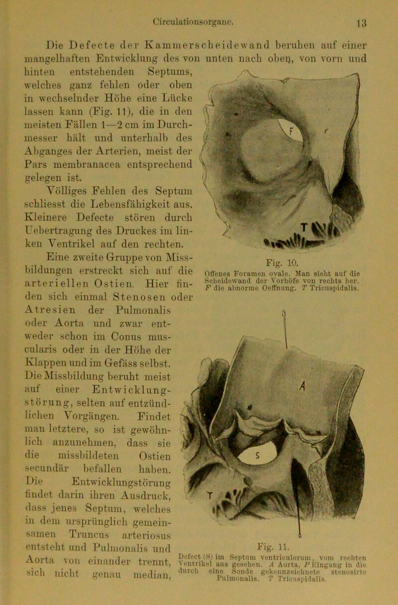 Fig. 10. Offenes Foramen ovale. Man sieht auf die Scheidewand der Vorhöfe von rechts her. F die abnorme Oeffnung. T Tricuspidalis. Die Defecte der Kamm er scheide wand beruhen auf einer mangelhaften Entwicklung des von unten nach obei), von vorn und hinten entstehenden Septums, welches ganz fehlen oder oben in wechselnder Höhe eine Lücke lassen kann (Fig. 11), die in den meisten Fällen 1—2 cm im Durch- messer hält und unterhalb des Abganges der Arterien, meist der Pars membranacea entsprechend gelegen ist. Völliges Fehlen des Septum schliesst die Lebensfähigkeit aus. Kleinere Defecte stören durch Uebertragung des Druckes im lin- ken Ventrikel auf den rechten. Eine zweite Gruppe von Miss- bildungen erstreckt sich auf die arteriellen Ostien. Hier fin- den sich einmal Stenosen oder Atresien der Pulmonalis oder Aorta und zwar ent- weder schon im Conus mus- cularis oder in der Höhe der Klappen und im Gefäss selbst. Die Missbildung beruht meist auf einer Entwicklung- störung, selten auf entzünd- lichen Vorgängen. Findet man letztere, so ist gewöhn- lich anzunehmen, dass sie die missbildeten Ostien secundär befallen haben. Die Entwicklungstörung findet darin ihren Ausdruck, dass jenes Septum, welches in dem ursprünglich gemein- samen Truncus arteriosus entsteht und Pulmonalis und F>g- u- A nrto vnn oi'nonflfl,. Defect (S) im Septum ventriculorum. vom rechten Oll einanclei ticnnt, \entriliel aus gesehen. A Aorta, PEingang in die sich liiolif tronon morlia« (lurcl> eine Sonde gekennzeichnete stenosirte 1111111 »enau meclian, PulmonaUs. T Trieusiddalis.