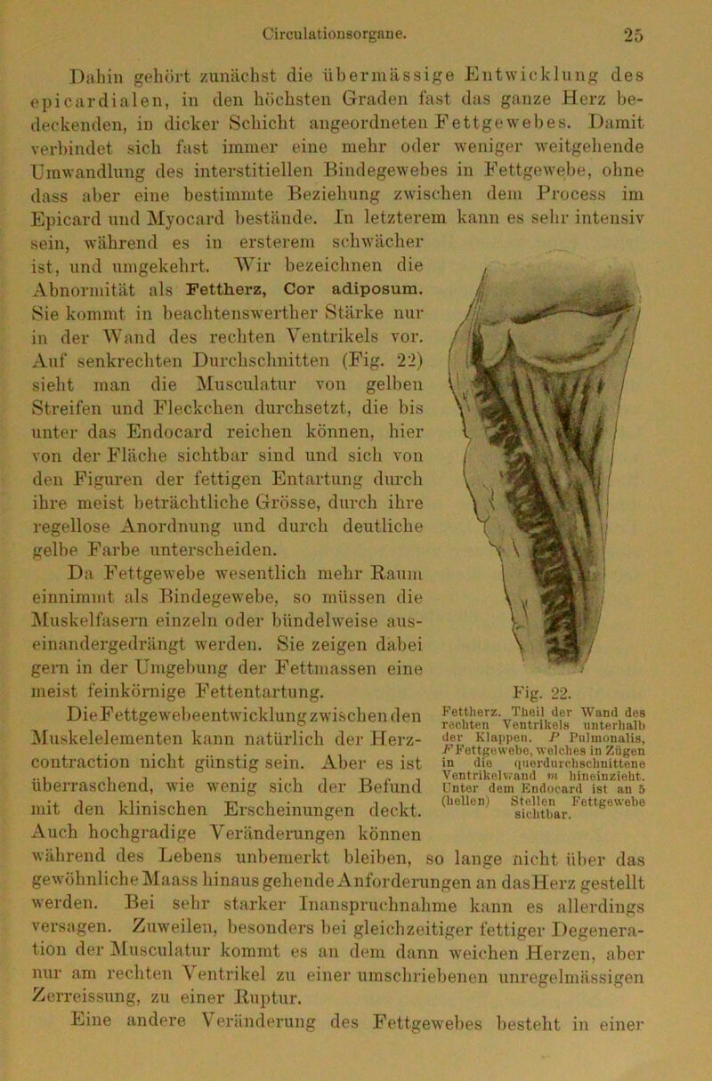 Dahin gehört zunächst die übermässige Entwicklung des epicardialen, in den höchsten Graden fast das ganze Herz be- deckenden, in dicker Schicht angeordneten Fettgewebes. Damit verbindet sich fast immer eine mehr oder weniger weitgehende Umwandlung des interstitiellen Bindegewebes in Fettgewebe, ohne dass aber eine bestimmte Beziehung zwischen dem Process im Epicard und Myocard bestände. In letzterem kann es sehr intensiv sein, während es in ersterem schwächer ist, und umgekehrt. Wir bezeichnen die Abnormität als Fettherz, Cor adiposum. Sie kommt in beachtenswerther Stärke nur in der Wand des rechten Ventrikels vor. Auf senkrechten Durchschnitten (Fig. 22) sieht man die Musculatur von gelben Streifen und Fleckchen durchsetzt, die bis unter das Endocard reichen können, hier von der Fläche sichtbar sind und sich von den Figuren der fettigen Entartung durch ihre meist beträchtliche Grösse, durch ihre regellose Anordnung und durch deutliche gelbe Farbe unterscheiden. Da Fettgewebe wesentlich mehr Raum einnimmt als Bindegewebe, so müssen die Muskelfasern einzeln oder bündelweise aus- einandergedrängt werden. Sie zeigen dabei gern in der Umgebung der Fettmassen eine meist feinkörnige Fettentartung. DieFettgewebeentwicklungzwischen den Muskelelementen kann natürlich der Herz- coutraction nicht günstig sein. Aber es ist überraschend, wie wenig sich der Befund mit den klinischen Erscheinungen deckt. Auch hochgradige Veränderungen können während des Lebens unbemerkt bleiben, so lange nicht über das gewöhnliche Maass hinaus gehende Anforderungen an dasHerz gestellt werden. Bei sehr starker Inanspruchnahme kann es allerdings versagen. Zuweilen, besonders bei gleichzeitiger fettiger Degenera- tion der Musculatur kommt es an dem dann weichen Herzen, aber nur am rechten V entrikel zu einer umschriebenen unregelmässigen Zerreissung, zu einer Ruptur. Eine andere Veränderung des Fettgewebes besteht in einer Fig. 22. Fettherz. Theil der Wand des rechten Ventrikels unterhalb der Klappen. P Pulmonaiis, /■’Fettgewebe, welches in Zügen in die querdurchschnittene Ventrikel vrand m hineinzieht. Unter dem Endocard ist an 5 (hellen) Stellen Fettgewebe sichtbar.