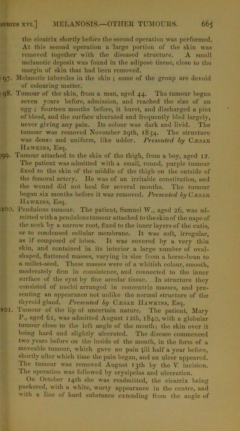 the cicatrix shortly before the second operation was performed. At this second operation a 'large portion of the skin was removed together with the diseased structure. A small melanotic deposit was found in the adipose tissue, close to the margin of skin that had been removed. 97. Melanotic tubercles in the skin ; some of the group are devoid of colouring matter. . 98. Tumour of the skin, from a man, aged 44. The tumour began seven years before, admission, and reached the size of an egg ; fourteen months before, it burst, and discharged a pint of blood, and the surface ulcerated and frequently bled largely, never giving any pain. Its colour was dark and livid. The tumour was removed November 29th, 1834. The structure was dense and uniform, like udder. Presented by Caesar Hawkins, Esq. 9Q- Tumour attached to the skin of the thigh, from a boy, aged 12. The patient was admitted with a small, round, purple tumour fixed to the skin of the middle of the thigh on the outside of the femoral artery. He was of an irritable constitution, and the wound did not heal for several months. The tumour began six months before it was removed. Presented by CLesar Hawkins, Esq. 100. Pendulous tumour. The patient, Samuel W., aged 26, was ad- mitted with a pendulous tumour attached to theskinof the nape of the neck by a narrow root, fixed to the inner layers of the cutis, or to condensed cellular membrane. It was soft, irregular, as if composed of lobes. It was covered by a very thin skin, and contained in its interior a large number of oval- shaped, flattened masses, varying in size from a horse-bean to a millet-seed. These masses were of a whitish colour, smooth, moderately firm in consistence, and connected to the inner surface of the cyst by fine areolar tissue. In structure they consisted of nuclei arranged in concentric masses, and pre- senting an appearance not unlike the normal structure of the thyroid gland. Presented by CAESAR Hawkins, Esq. 101. Tumour of the lip of uncertain nature. The patient, Mary P., aged 6x, was admitted August 12th, 1840, with a globular tumour close to the left angle of the mouth; the skin over it being hard and slightly ulcerated. The disease commenced two years before on the inside of the mouth, in the form of a moveable tumour, which gave no pain till half a year before, shortly after which time the pain began, and an ulcer appeared. The tumour was removed August 13th by the V incision. The operation was followed by erysipelas and ulceration. On October 14th she was readmitted, the cicatrix being puckered, with a white, warty appearance in the centre, and with a line of hard substance extending from the angle of
