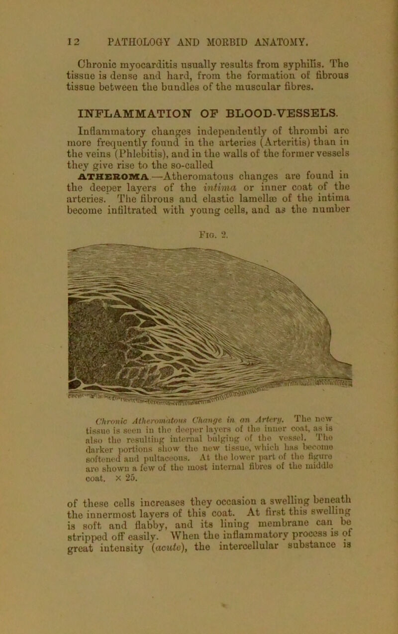 Chronic myocarditis usually results from syphilis. The tissue is dense and hard, from the formation of fibrous tissue between the bundles of the muscular fibres. INFLAMMATION OF BLOOD-VESSELS. Inflammatory changes independently of thrombi arc more frequently found in the arteries (Arteritis) than in the veins (Phlebitis), and in the walls of the former vessels they give rise to the so-called atheroma. —Atheromatous changes are found in the deeper layers of the intima or inner coat of the arteries. The fibrous and elastic lamell® of the intima become infiltrated with young cells, and as the number Fio. 2. Chronic Atheromatous Change in an Artery. The new tissuo is seen in the deeper layers of the inner coat, as is also the resulting internal bulging of the vessel. The darker portions show the now tissue, which has become softened and pultaceons. At the lower part of the figure are shown a few of the most internal fibres of the middle coat, x 25. of these cells increases they occasion a swelling beneath the innermost layers of this coat. At first this swelling is soft and flabby, and its lining membrane can be stripped off easily. When the inflammatory process is ol great intensity (acute), the intercellular substance is