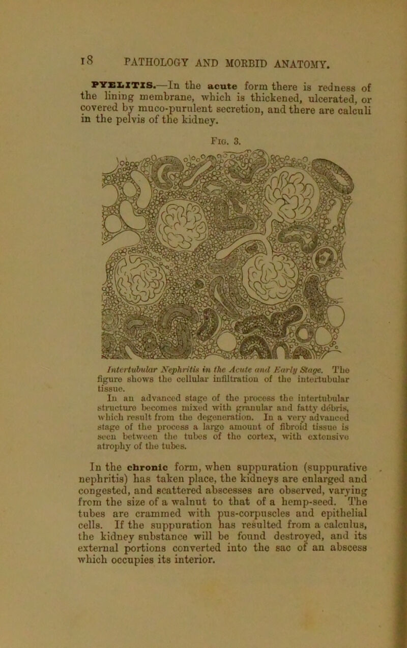 pyelztzs.—In the acute form there is redness of the lining membrane, which is thickened, ulcerated, or covered bv muco-purulent secretion, and there are calculi in the pelvis of the kidney. Fig. 3. Intertubular Nephritis in the Acute uml Early Stage. The figure shows the cellular infiltration of the intertubular tissue. In an advanced stage of the process the intertubular structure becomes mixed with granular and fatty debris, which result from the degeneration. In a very advanced stage of the process a largo amount of fibroid tissue is seen between the tubes of the cortex, with extensive atrophy of the tubes. In the chronic form, when suppuration (suppurative nephritis) has taken place, the kidneys are enlarged and congested, and scattered abscesses are observed, varying from the size of a walnut to that of a hemp-seed. The tubes are crammed with pus-corpuscles and epithelial cells. If the suppuration has resulted from a calculus, the kidney substance will be found destroyed, and its external portions converted into the sac of an abscess which occupies its interior.