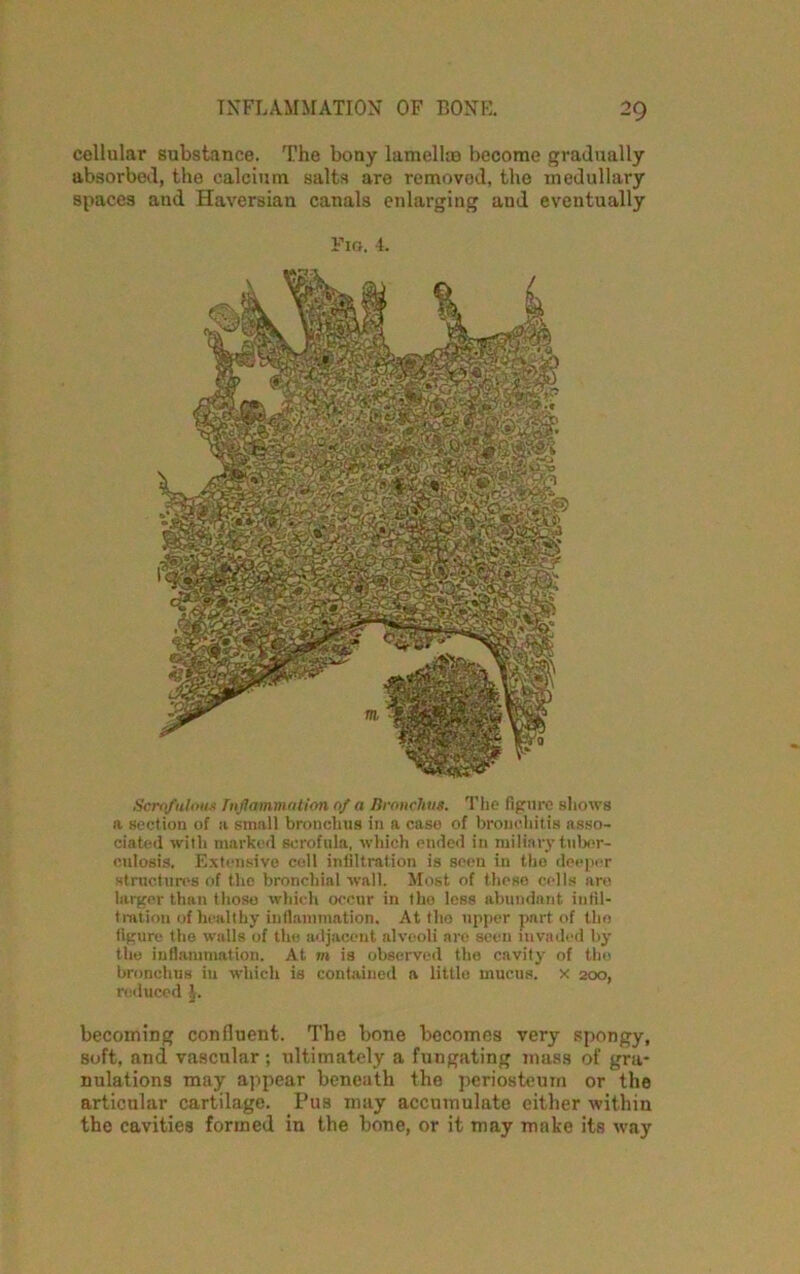 cellular substance. The bony lamell® become gradually absorbed, the calcium salts are removed, the medullary spaces and Haversian canals enlarging aud eventually Fig. 4. Scrofulous Inflammation of a Bronchus. The figure shows a section of a small bronchus in a case of bronchitis asso- ciated with marked scrofula, which ended in miliary tuber- culosis. Extensive coll infiltration is seen in the deeper structures of the bronchial wall. Most of these cells are larger than those which occur in the less abundant infil- tration of healthy inflammation. At the upper part of the figure the walls of the adjacent alveoli are seen invaded by the inflammation. At m is observed the cavity of the bronchus in which is contained a little mucus, x 200, reduced becoming confluent. Tbe bone becomes very spongy, soft, and vascular ; ultimately a fungating mass of gra- nulations may appear beneath the periosteum or the articular cartilage. Pus may accumulate either within the cavities formed in the bone, or it may make its way