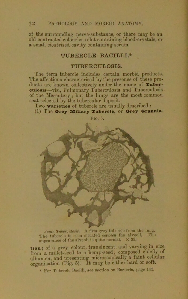 of the surrounding: nerve-substance, or there may be an old contracted colourless clot containing blood-crystals, or a small cicatrised cavity containing serum. TUBERCLE BACILLI * TUBERCULOSIS. The term tubercle includes certain morbid products. The affections characterised by the presence of these pro- ducts are known collectively under the name of Tuber- culosis—viz., Pulmonary Tuberculosis and Tuberculosis of the Mesentery; but the lungs are the most common seat selected by the tubercular deposit. Two Varieties of tubercle are usually described : (1) The Grey Miliary Tubercle, or Grey Granula- Fio. 5. Acute Tuberculosis. A firm grey tubercle from the lung. The tubercle is seen situated between the alveoli. The appearance of the alveoli is quite normal. X 33. tion; of a grey colour, translucent, and varying in size from a millet-seed to a hemp-seed; composed chiefly of albumen, and presenting microscopically a faint cellular organisation (Fig. 5). It may be either hard or soft. * For Tubercle Bacilli, see section on Bacteria, page 141.