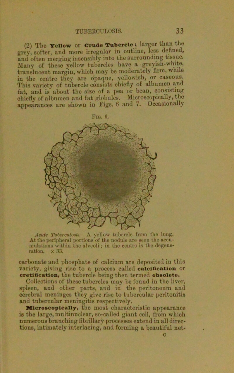 (2) The Yellow or Crude Tubercle ; larger than the grey, softer, and more irregular in outline, less defined, and often merging insensibly into the surrounding tissue. Many of these yellow tubercles have a greyish-white, translucent margin, which may be moderately firm, while in the centre they are opaque, yellowish, or caseous. This variety of tubercle consists chielly of albumen and fat, and is about the size of a pea or bean, consisting chiefly of albumen and fat globules. Microscopically, the appearances are shown in Figs. 6 and 7. Occasionally Fig. 6. A cute Tuberculosis. A yellow tubercle from the lung. At the peripheral portions of the nodule are seen the accu- mulations within the alveoli; in the centra is the degene- ration. x 33. carbonate and phosphate of calcium are deposited in this variety, giving rise to a process called calcification or cretification, the tubercle being then termed obsolete. Collections of these tubercles may be found in the liver, spleen, and other parts, and in the peritoneum and cerebral meninges they give rise to tubercular peritonitis and tubercular meningitis respectively. Microscopically, the most characteristic appearance is the large, multinuclear, so-called giant cell, from which numerous branching fibrillary processes extend in all direc- tions, intimately interlacing, and forming a beautiful net- c