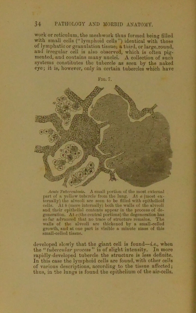 work or reticulum, the meshwork thus formed being filled with small cells ('‘lymphoid cells) identical with those of lymphatic or granulation tissue; a tiiird, or large,round, and irregular cell is also observed, which is often pig- mented, and contains many nuclei. A collection of such systems constitutes the tubercle as seen by the naked eye; it is, however, only in certain tubercles which have Fig. 7. Acute Tuberculosis. A small portion of the most external part of a yellow tubercle from the lung. At a (most ex- ternally) the alveoli are seen to be filled with epithelioid cells. At b (more internally) both the walls of the alveoli and their epithelial contents appear in the process of de- generation. At c (the central poriions) the degeneration has so far advanced that no trace of structure remains. The walls of the alveoli are thickened by a small-celled growth, and at one part is visible a minute mass of this small-celled tissue. developed slowly that the giant cell is found—i.e., when the “tubercular process” is of slight intensity. In more rapidly-developed tubercle the structure is less definite. In this case the lymphoid cells are found, with other cells of various descriptions, according to the tissue affected; thus, in the lungs is found the epithelium of the air-cells.
