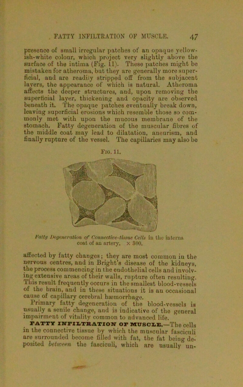 presence of small irregular patches of an opaque yellow- ish-white colour, which project very slightly above the surface of the intiraa (Fig. 11). These patches might be mistaken for atheroma, but they are generally more super- ficial, and are readily stripped off from the subjacent layers, the appearance of which is natural. Atheroma affects the deeper structures, and, upon removing the superficial layer, thickening and opacity are observed beneath it. The opaque patches eventually break down, leaving superficial erosions which resemble those so com- monly met with upon the mucous membrane of the stomach. Fatty degeneration of the muscular fibres of the middle coat may lead to dilatation, aneurism, and finally rupture of the vessel. The capillaries may also bo fully Degeneration of Connective-tissue Cells in the interna coat of an artery, x 300. affected by fatty changes; they are most common in the nervous centres, and in Bright’s disease of the kidneys, the process commencing in the endothelial cells and involv- ing extensive areas of their walls, rupture often resulting. This result frequently occurs in the smallest blood-vessels of the brain, and in these situations it is an occasional cause of capillary cerebral haemorrhage. Primary fatty degeneration of the blood-vessels is usually a senile change, and is indicative of the general impairment of vitality common to advanced life. PATTY INFILTRATION OF MUSCLE,—The Cells in the connective tissue by which the muscular fasciculi are surrounded become filled with fat, the fat being de- posited between the fasciculi, which are usually un- Fig. 11.