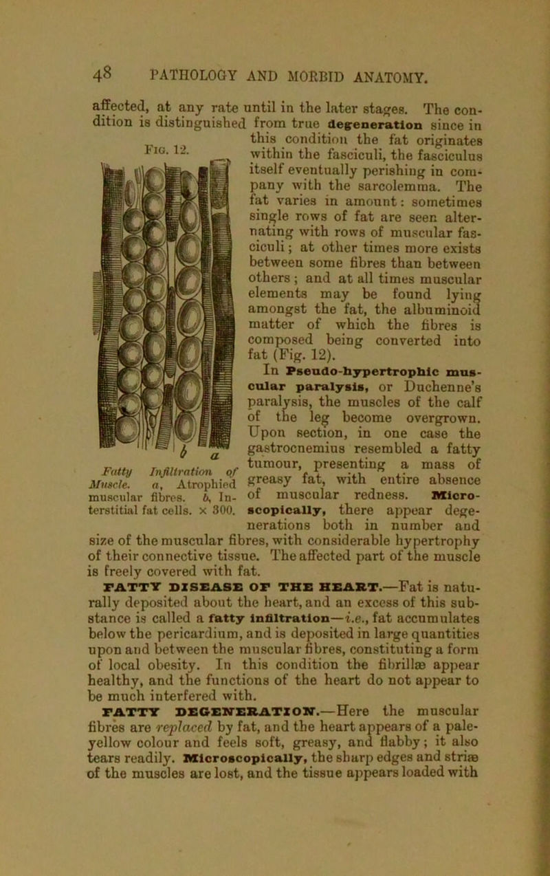 affected, at any rate until in the later stages. The con- dition is distinguished from true degeneration since in this condition the fat originates within the fasciculi, the fasciculus itself eventually perishing in com- pany with the sarcolemma. The fat varies in amount: sometimes single rows of fat are seen alter- nating with rows of muscular fas- ciculi ; at other times more exists between some fibres than between others ; and at all times muscular elements may be found lying amongst the fat, the albuminoid matter of which the fibres is composed being converted into fat (Fig. 12). In Pseudo-hypertrophic mus- cular paralysis, or Duchenne’s paralysis, the muscles of the calf of the leg become overgrown. Upon section, in one case the gastrocnemius resembled a tumour, presenting a ma greasy fat, with entire absence of muscular redness. Micro- scopically, there appear dege- nerations both in number and size of the muscular fibres, with considerable hypertrophy of their connective tissue. The affected part of the muscle is freely covered with fat. TATTY DISEASE or THE heart.—Fat is natu- rally deposited about the heart, and an excess of this sub- stance is called a fatty infiltration—i.e., fat accumulates below the pericardium, and is deposited in large quantities upon and between the muscular fibres, constituting a form of local obesity. In this condition the fibrillae appear healthy, and the functions of the heart do not appear to be much interfered with. FATTY degeneration.—Here the muscular fibres are replaced by fat, and the heart appears of a pale- yellow colour and feels soft, greasy, and flabby; it also tears readily. Microscopically, the sharp edges and striae of the muscles are lost, and the tissue appears loaded with fatty is of Fig. 12. Fatty Infiltration of Muscle. a. Atrophied muscular fibres. 6, In- terstitial fat cells, x 300.