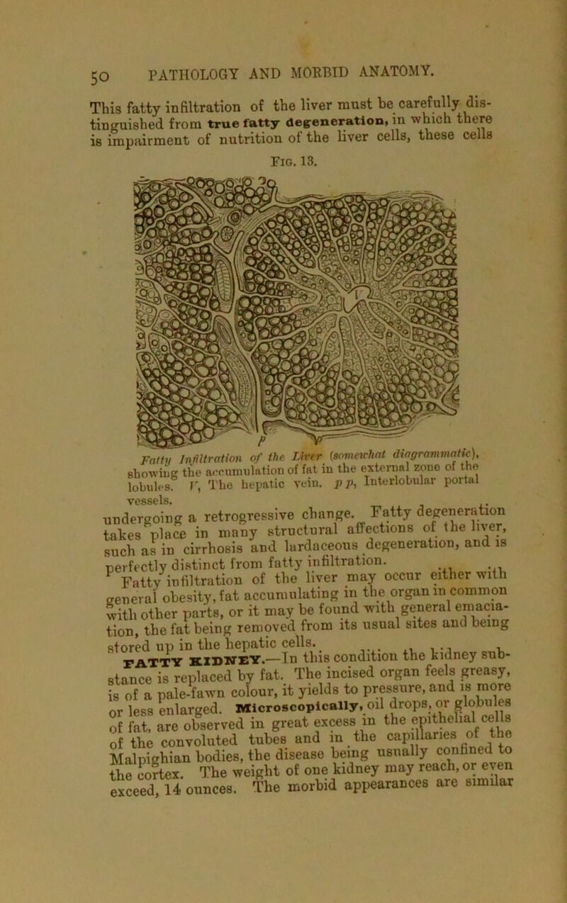 This fatty infiltration of the liver must be carefully dis- tinguished from true fatty degeneration, in which there is impairment of nutrition oi the liver cells, these cells Fig. 13. Patty Infiltration of the J.irer (sonmrhat diagrammatic), showing the accumulation of fat in the externa zone of the lobules, r, The hepatic vein, p p, Interlobular portal vessels. . mdergoing a retrogressive change. Fatty degeneration akes''place in many structural affections of the liver, uich as in cirrhosis and lardaceons degeneration, and is perfectly distinct from fatty infiltration. Fatty infiltration of the liver may occnr either with general obesity, fat accumulating in the organ in common with other parts, or it may be found with general emacia- tion, the fat being removed from its usual sites and being stored up iD the hepatic cells. . , PATTY KIDNEY.—In this condition the kidney sub- stance is replaced by fat. The incised organ feels greasy, is of a pale-fawn colour, it yields to pressure, and is more or less enlarged. Microscopically, oil drops or globules of fat, are observed in great excess in the epithelial cells of the convoluted tubes and in the eapi Wies of t e Malpighian bodies, the disease being usnally confined to the cortex. The weight of one kidney may reach, or even exceed, 14 ounces. The morbid appearances are similar