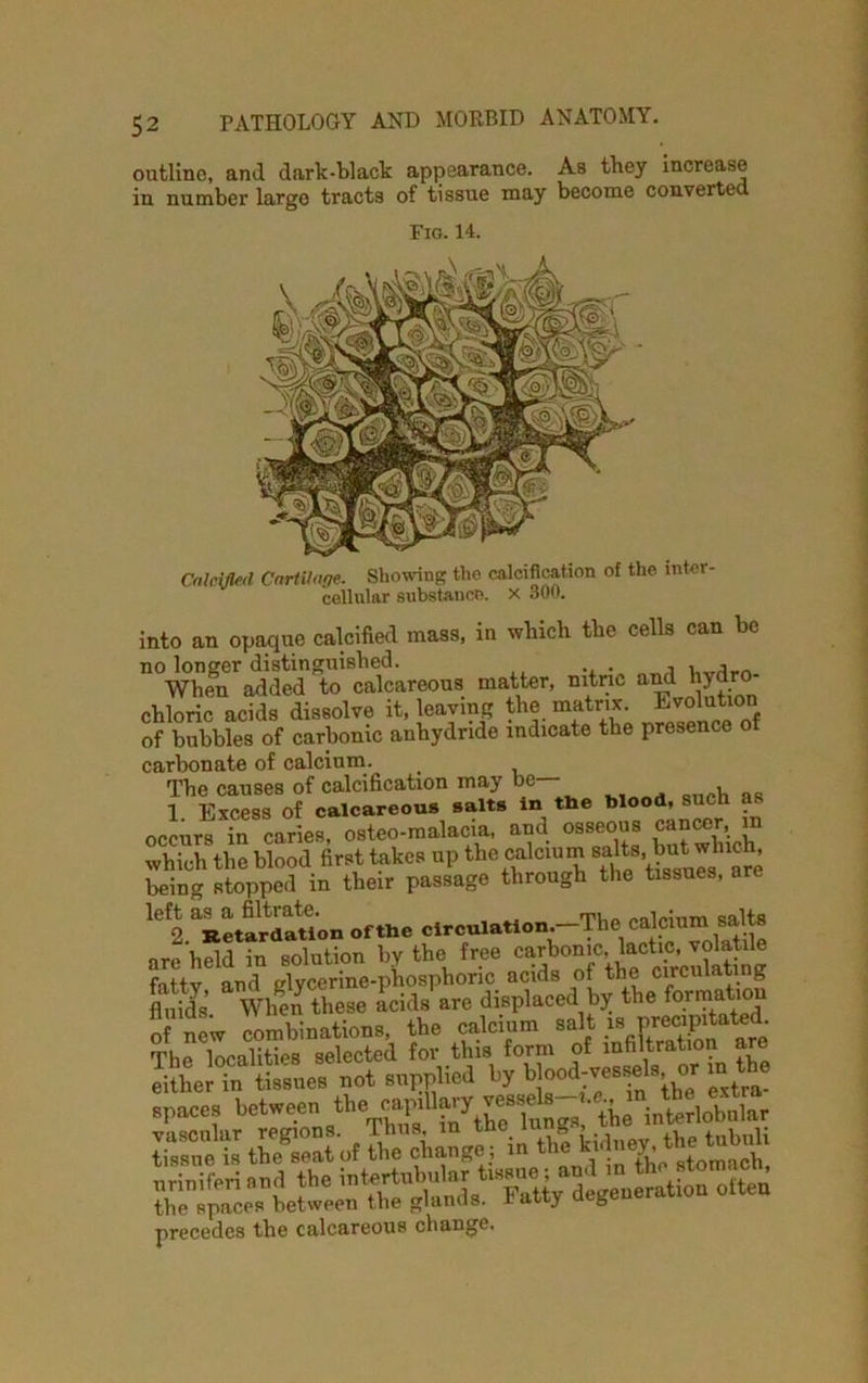 outline, and dark-black appearance. As they increase in number largo tracts of tissue may become converted Fig. 14. Calcified Cartilage. Showing the calcification of the inter cellular substance, x 300. into an opaque calcified mass, in which the cells can be no longer distinguished. \,vArn When added to calcareous matter, nitric and hydro chloric acids dissolve it, leaving the matrix. Evolution of bubbles of carbonic anhydride indicate the presence of carbonate of calcium. < The causes of calcification may »c u 1 Excess of calcareous salts in the blood, sucli as occurs in caries, osteo-malacia, and osseous cancer m which the blood first takes up the calcium salts, but which being stopped in tbeir passage through the tissues, are 1C 2 Retardation of the circulation.—The calcium salts are held in solution by the free carbonic, lactic, volatile fattv and glycerine-phosphoric acids of the circulating Ms When these acids are displaced by the formation new combinations, the calcium salt The localities selected for this form of infiltration are .pace, bet.een the uriniferiand the intertubular tissue; and in the_stomac; ihe IpncoAotween the Fatty degenerate otten precedes the calcareous change.