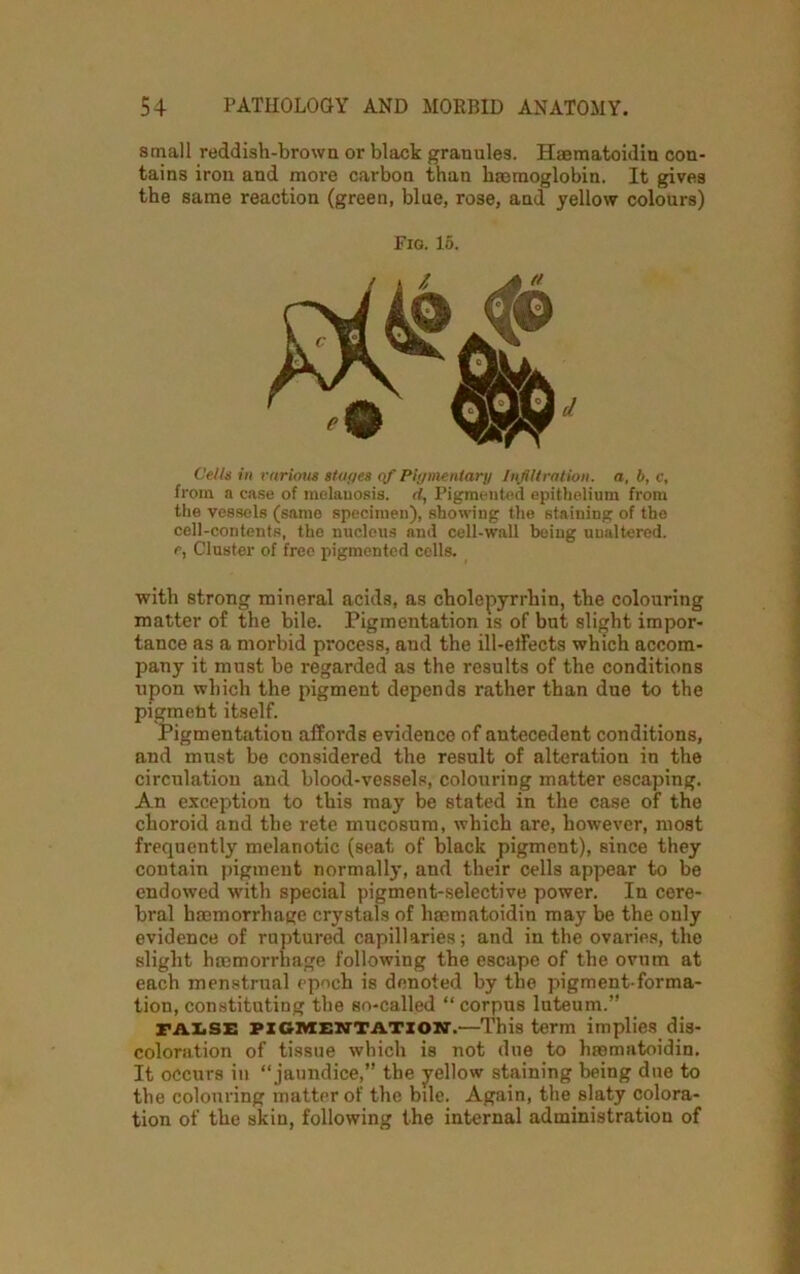 small reddish-brown or black granules. Haematoidin con- tains iron and more carbon than haemoglobin. It gives the same reaction (green, blue, rose, and yellow colours) Fig. 15. d Cells in various stages qf Pigmentary Infiltration, a, b, c, from a case of melanosis, d, Pigmented epithelium from the vessels (same specimen), showing the staining of the cell-contents, the nucleus and cell-wall being unaltered. r, Cluster of free pigmented cells. with strong mineral acids, as cholepyrrhin, the colouring matter of the bile. Pigmentation is of but slight impor- tance as a morbid process, and the ill-elFects which accom- pany it must be regarded as the results of the conditions upon which the pigment depends rather than due to the pigment itself. Pigmentation affords evidence of antecedent conditions, and must be considered the result of alteration in the circulation and blood-vessels, colouring matter escaping. An exception to this may be stated in the case of the choroid and the rete mucosum, which are, however, most frequently melanotic (seat of black pigment), since they contain pigment normally, and their cells appear to be endowed with special pigment-selective power. In cere- bral haemorrhage crystals of haematoidin may be the only evidence of ruptured capillaries; and in the ovaries, the slight haemorrhage following the escape of the ovum at each menstrual epoch is denoted by the pigment-forma- tion, constituting the so-called “ corpus luteum.” FALSE PIGMENTATION.—This term implies dis- coloration of tissue which is not due to haematoidin. It occurs in “jaundice,” the yellow staining being due to the colouring matter of the bile. Again, the slaty colora- tion of the skin, following the internal administration of