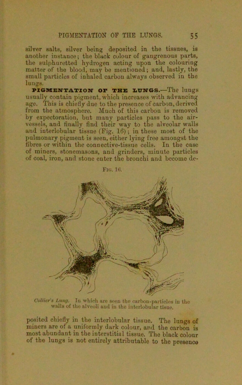 silver salts, silver being deposited in tbe tissues, is another instance; the black colour of gangrenous parts, the sulphuretted hydrogen acting upon the colouring matter of the blood, may be mentioned; and, lastly, the small particles of inhaled carbon always observed in the lungs. PICMENTATIOH OF THE LUNGS.—The lungs usually contain pigment, which increases with advancing age. This is chiefly due to the presence of carbon, derived from the atmosphere. Much of this carbon is removed by expectoration, but many particles pass to the air- vessels, and finally find their way to the alveolar walls and interlobular tissue (Fig. 16); in these most of the pulmonary pigment is seen, either lying free amongst the fibres or within the connective-tissue cells. In the case of miners, stonemasons, and grinders, minute particles of coal, iron, and stone enter the bronchi and become de- Fig. It;. Collier'8 Lung. In which are seen the carbon-particles iu the walls of the alveoli and in the interlobular tisue. posited chiefly in the interlobular tissue. The lungs of miners are of a uniformly dark colour, and the carbon is most abundant in the interstitial tissue. The black colour of the lungs is not entirely attributable to the presence