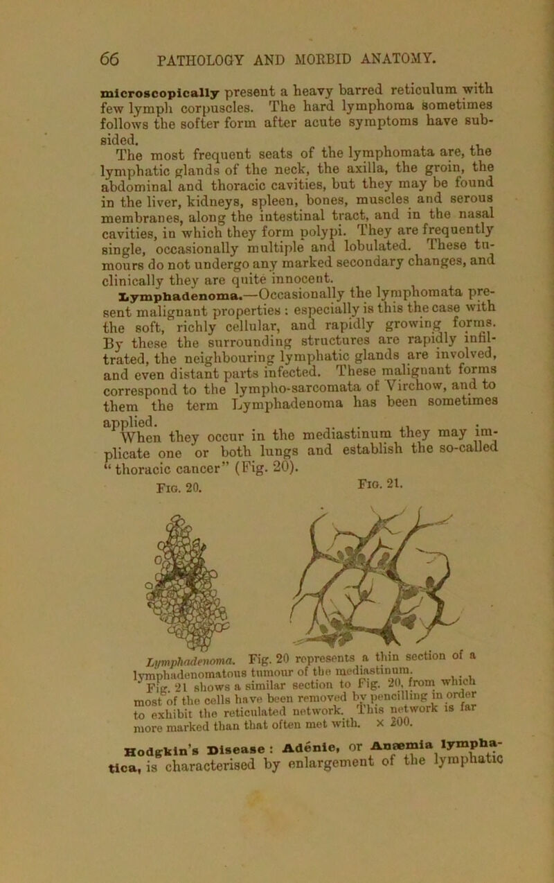 microscopically present a heavy barred reticulum with few lymph corpuscles. The hard lymphoma sometimes follows the softer form after acute symptoms have sub- sided. The most frequent seats of the lymphomata are, the lymphatic glands of the neck, the axilla, the groin, the abdominal and thoracic cavities, but they may be found in the liver, kidneys, spleen, bones, muscles and serous membranes, along the intestinal tract, and in the nasal cavities, in which they form polypi. They are frequently single, occasionally multiple and lobulated. These tu- mours do not undergo any marked secondary changes, and clinically they are quite innocent. Lympbadenoma.—-Occasionally the lymphomata pre- sent malignant properties : especially is this the case with the soft, richly cellular, and rapidly growing forms. By these the surrounding structures are rapidly inhl- trated, the neighbouring lymphatic glands are involved, and even distant parts infected. These malignant forms correspond to the lympho-sarcomata of Virchow, and to them the term Lymphadenoma has been sometimes applied. ,, When they occur in the mediastinum they may im- plicate one or both lungs and establish the so-called “ thoracic cancer” (Fig. 20). Fig. 20. Fig. 21. Lymphadenoma. Fig. 20 represents a thin section of a rnphadenomatous tumour of the mediftstmum. Fitr 21 shows a similar section to Fig. 20, from which ostof the cells have been removed by pencilling in order i exhibit the reticulated network. This network is far ore marked than that often met with. x 200. Hodgkin's Disease : Adenie, or Anaemia lympha- tica, is characterised by enlargement of the lymphatic