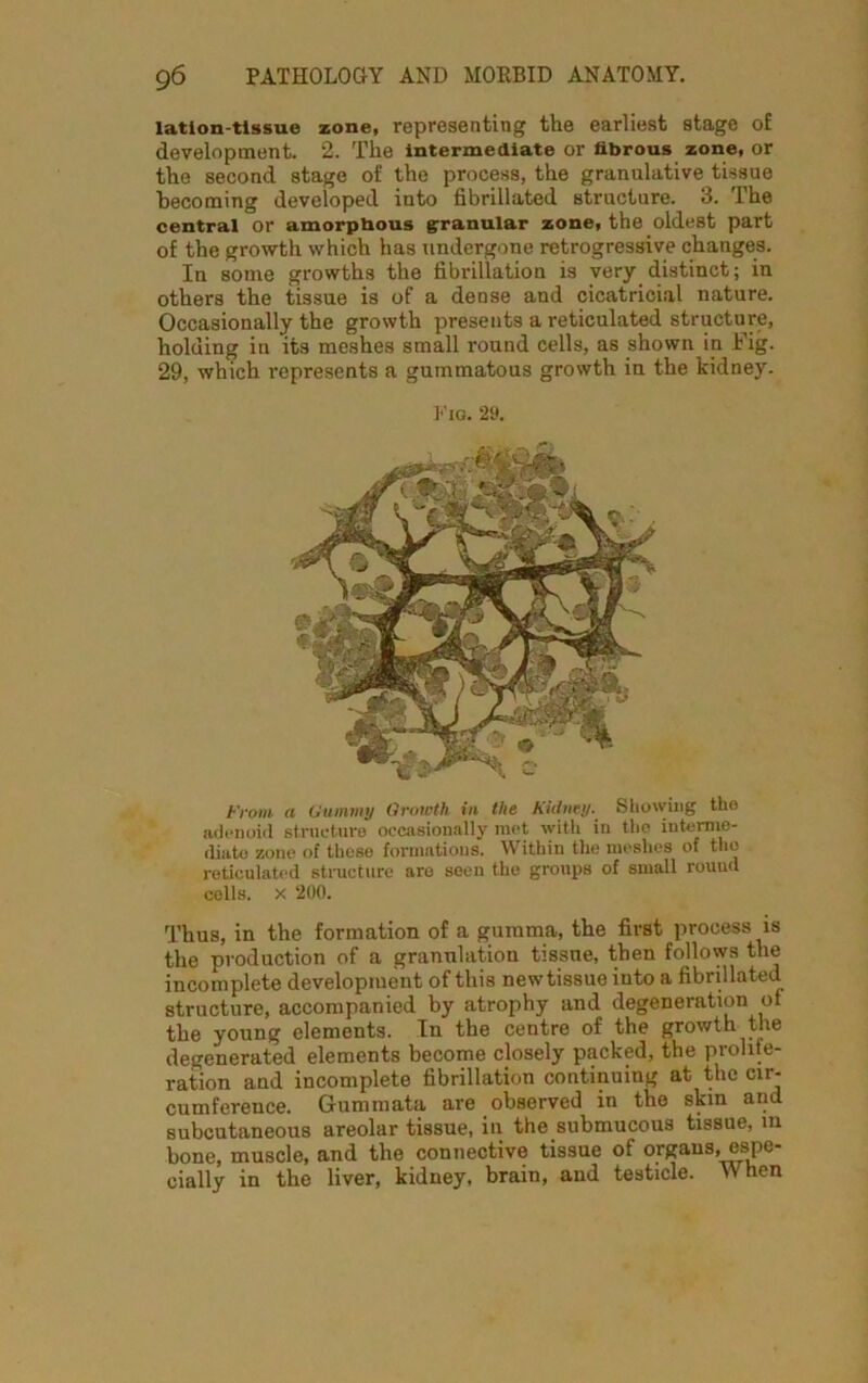 lation-tissue zone, representing the earliest stage of development. 2. The intermediate or fibrous zone, or the second stage of the process, the granulative tissue becoming developed into fibrillated structure. 3. The central or amorphous granular zone, the oldest part of the growth which has undergone retrogressive changes. In some growths the fibrillation is very distinct; in others the tissue is of a dense and cicatricial nature. Occasionally the growth presents a reticulated structure, holding in its meshes small round cells, as shown in Fig. 29, which represents a gummatous growth in the kidney. Fig. 29. From a Gummy Growth in the Kidney. Showing tho adenoid structure occasionally met with in tho interme- diate zone of these formations. Within the meshes of tho reticulated structure aro seen the groups of small round cells, x 200. Thus, in the formation of a gumma, the first process is the production of a granulation tissue, then follows the incomplete development of this new tissue iuto a fibrillated structure, accompanied by atrophy and degeneration of the young elements. In the centre of the growth the degenerated elements become closely packed, the prolife- ration and incomplete fibrillation continuing at the cir- cumference. Gummata are observed in the skm and subcutaneous areolar tissue, in the submucous tissue, in bone, muscle, and the connective tissue of organs, espe- cially in the liver, kidney, brain, and testicle. \\ hen