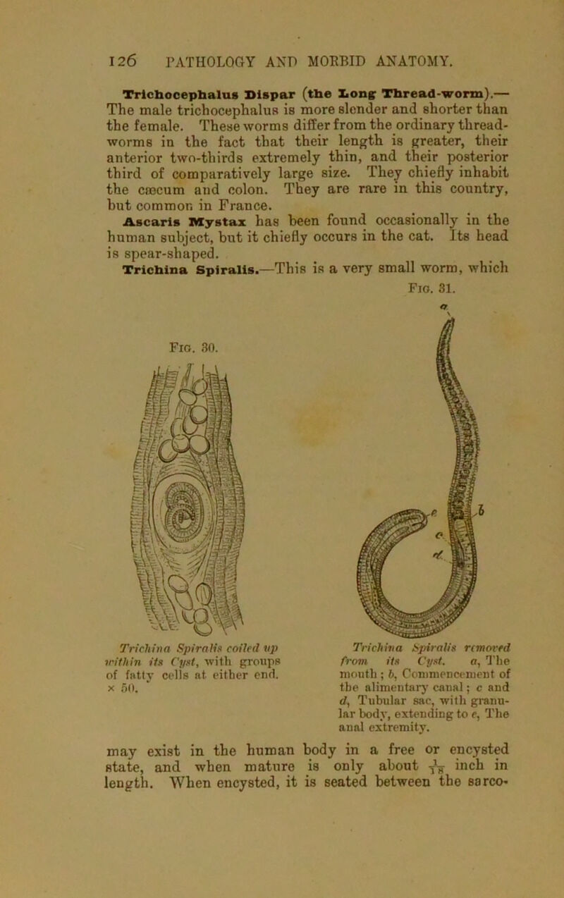 Trichocephalus Dispar (the Long Thread-worm).— The male trichocephalus is more slender and shorter than the female. These worms differ from the ordinary thread- worms in the fact that their length is greater, their anterior two-thirds extremely thin, and their posterior third of comparatively large size. They chiefly inhabit the cnecum and colon. They are rare in this country, but common in France. Ascaris lviystax has been found occasionally in the human subject, but it chiefly occurs in the cat. Its head is spear-shaped. Trichina Spiralis.—This is a very small worm, which Fig. 31. Fig. 30. Trichina Spiralis coiled up within its Cyst, with groups of fattv cells at either end. x 60. Trichina Spiralis removed from its Cyst. a, The month ; h, Commencement of the alimentary cnual; c and d, Tubular sac, with granu- lar body, extending to e, The anal extremity. may exist in the human body in a free or encysted state, and when mature is only about -fa inch in length. When encysted, it is seated between the sarco-
