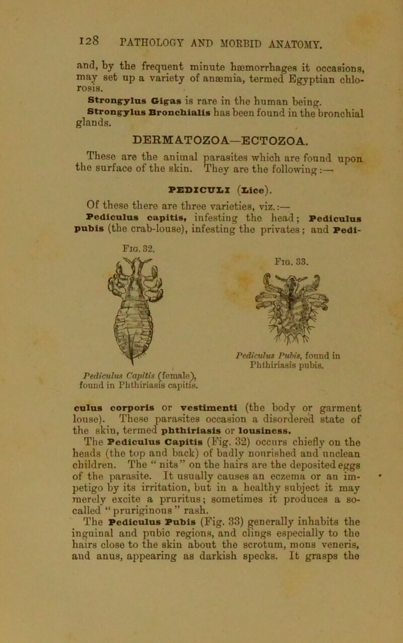 and, by the frequent minute haemorrhages it occasions, may set up a variety of anaemia, termed Egyptian chlo- rosis. Strong^rius Gigras is rare in the human being. Strongylus Bronchialis has been found in the bronchial glands. DERMATOZOA—ECTOZOA. These are the animal parasites which are found upon the surface of the skin. They are the following:— PEDICU1I (lice). Of these there are three varieties, viz.:— Pediculus capitis, infesting the head; Pediculus pubis (the crab-louse), infesting the privates; and Pedi- Fio. 32. I Pediculus Capitis (female), found in Phthiriasis capitis. cuius corporis or vestimenti (the body or garment louse). These parasites occasion a disordered state of the skiu, termed phthiriasis or lousiness. The Pediculus Capitis (Fig. 32) occurs chiefly on the heads (the top and back) of badly nourished and unclean children. The “ nits” on the hairs are the deposited eggs of the parasite. It usually causes an eczema or an im- petigo by its irritation, but in a healthy subject it may merely excite a pruritus; sometimes it produces a so- called “pruriginons ” rash. The Pediculus Pubis (Fig. 33) generally inhabits the inguinal and pubic regions, and clings especially to the hairs close to the skin about the scrotum, roons veneris, and anus, appearing as darkish specks. It grasps the Fio. 33. Pediculus Pubis, found in Phthiriasis pubis.