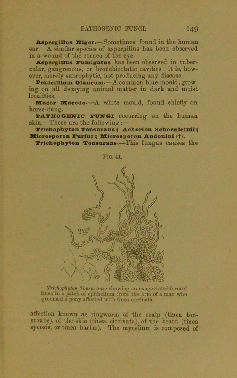 Aspergillus Niger.—Sometimes found in the human ear. A similar species of aspergillus lias been observed in a wound of the cornea of the eye. Aspergillus Fumigatus has Deen observed in tuber- cular, gangrenous, or bronchiectatic cavities : it is, how- ever, merely saprophytic, not producing any disease. Penlcilllum Glaucum.—A common blue mould, grow ing on all decaying animal matter in dark and moist localities. Mucor Mucedo.—A white mould, found chiefly on horse-dung. pathogenic FUNGI occurring on the human skin.—These are the following :— Trichophyton Tonsurans ; Acborion Schoenlelnll; Microsporon Furfur; Microsporon Audouinl (f). Trichophyton Tonsurans.—This fungus causes the Fig. 41. Trichophyton Tonsurans: showing an exaggerated form of tinea in a patch of epithelium from the arm of a man who groomed a pony affected with tinea circinnta. affection known as ringworm of the scalp (tinea ton- surans), of the skin (tinea circinata), of the beard (tinea sycosis, or tinea barbae). The mycelium is comjiosed of