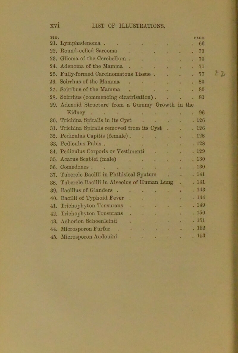 FIG. PAGE 21. Lymphadenoma 66 22. Round-celled Sarcoma 70 23. Glioma of the Cerebellum 70 24. Adenoma of the Mamma 71 25. Fully-formed Carcinomatous Tissue . . . .77 26. Scirrhus of the Mamma 80 27. Scirrhus of the Mamma . . . . .80 28. Scirrhus (commencing cicatrisation). . . .81 29. Adenoid Structure from a Gummy Growth in the Kidney 96 30. Trichina Spiralis in its Cyst 126 31. Trichina Spiralis removed from its Cyst . . 126 32. Pediculus Capitis (female) 128 33. Pediculus Pubis 128 34. Pediculus Corporis or Vestimenti .... 129 35. Acarus Scabiei (male) 130 36. Comedones 130 37. Tubercle Bacilli in Phthisical Sputum . . . 141 38. Tubercle Bacilli in Alveolus of Human Lung . . 141 39. Bacillus of Glanders 143 40. Bacilli of Typhoid Fever 144 41. Trichophyton Tonsurans 149 42. Trichophyton Tonsurans 150 43. Achorion Schoenleinii 151 44. Microsporon Furfur 152 45. Microsporon Audouini 153