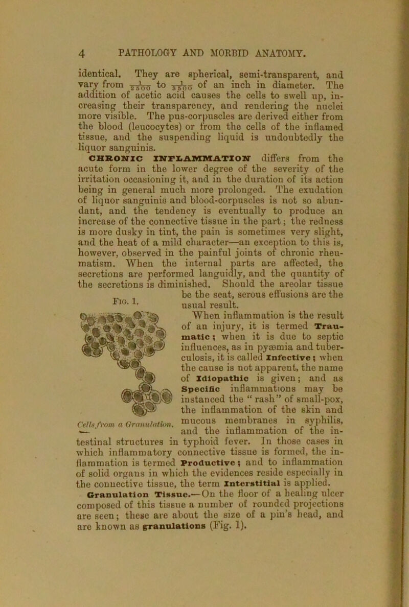 identical. They are spherical, semi-transparent, and vary from to of an inch in diameter. The addition of acetic acid causes the cells to swell up, in- creasing their transparency, and rendering the nuclei more visible. The pus-corpuscles are derived either from the blood (leucocytes) or from the cells of the inflamed tissue, and the suspending liquid is undoubtedly the liquor sanguinis. chronic INFLAMMATION differs from the acute form in the lower degree of the severity of the irritation occasioning it, and in the duration of its action being in general much more prolonged. The exudation of liquor sanguinis and blood-corpuscles is not so abun- dant, and the tendency is eventually to produce an increase of the connective tissue in the part; the redness is more dusky in tint, the pain is sometimes very slight, and the heat of a mild character—an exception to this is, however, observed in the painful joints of chronic rheu- matism. When the internal parts are affected, the secretions are performed languidly, and the quantity of the secretions is diminished. Should the areolar tissue be the seat, serous effusions are the usual result. When inflammation is the result of an injury, it is termed Trau- matic ; when it is due to septic influences, as in pyasmia and tuber- culosis, it is called infective; when the cause is not apparent, the name of Idiopathic is given; and as Specific inflammations may be instanced the “ rash” of small-pox, the inflammation of the skin and mucous membranes in syphilis, and the inflammation of the in- testinal structures in typhoid fever. In those cases in which inflammatory connective tissue is formed, the in- flammation is termed Productive; and to inflammation of solid organs in which the evidences reside especially in the connective tissue, the term interstitial is applied. Granulation Tissue.—On the floor of a healing ulcer composed of this tissue a number of rounded projections are seen; these are about the size of a pin’s head, and are known as granulations (Fig. 1). Fig. 1. Cells from ft Granulation.