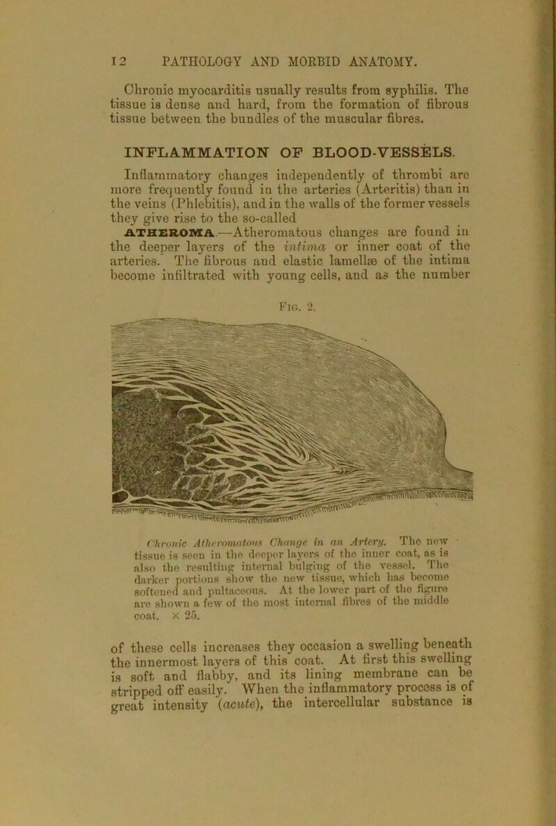 Chronic myocarditis usually l'esults from syphilis. The tissue is dense and hard, from the formation of fibrous tissue between the bundles of the muscular fibres. INFLAMMATION OF BLOOD-VESSELS. Inflammatory changes independently of thrombi are more frequently found in the arteries (Arteritis) than in the veins (Phlebitis), and in. the walls of the former vessels they give rise to the so-called atheroma—Atheromatous changes are found in the deeper layers of the inlirna or inner coat of the arteries. The fibrous and elastic lamellae of tbe intima become infiltrated with young cells, and as the number Fig. 2. Chronic Atheromatous Change in an Artery. The new tissue is seen in the deeper layers of the inner coat, as is also the resulting internal bulging of the vessel. The darker portions show the new tissue, which has become softened and pultaceous. At the lower part of the figure are shown a few of the most internal fibres of the middle coat. X 25. of these cells increases they occasion a swelling beneath the innermost layers of this coat. At first this swelling is soft and flabby, and its lining membrane can be stripped off easily. When tho inflammatory process is of great intensity (acute), the intercellular substance is