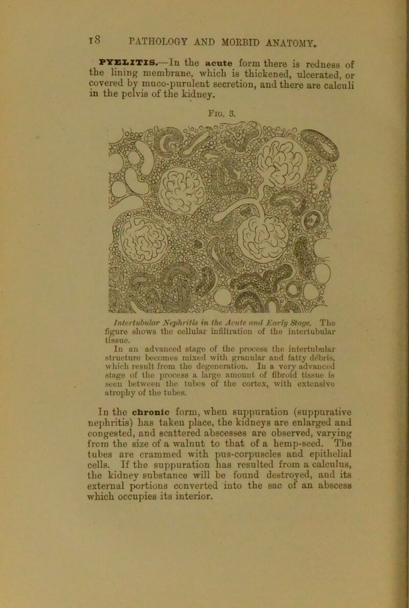 pyelitis.—In the acute form there is redness of the lining membrane, which is thickened, ulcerated, or covered by muco-purulent secretion, and there are calculi in the pelvis of the kidney. Fio. 3. Intertubular Nephritis in the Acute and Early Stage. Tlio figure shows tho cellular infiltration of the intertubular tissue. In an advanced stage of the process the intertubular structure becomes mixed with granular and fatty ddbris, which result from the degeneration. In a very advanced stage of the process a largo amount of fibroid tissue is seen between the tubes of the cortex, writh extensive atrophy of the tubes. In the chronic form, when suppuration (suppurative nephritis) has taken place, the kidneys are enlarged and congested, and scattered abscesses are observed, varying from the size of a walnut to that of a hemp-seed. The tubes are crammed with pus-corpuscles and epithelial cells. If the suppuration has resulted from a calculus, the kidney substance will be found destroyed, and its external portions converted into the sac of an abscess which occupies its interior.