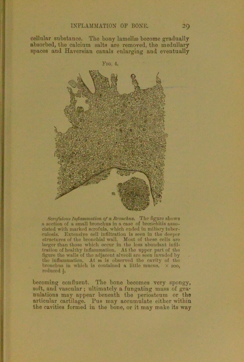 cellular substance. The bony lamellae become gradually absorbed, the calcium salts are removed, the medullary spaces and Haversian canals enlarging and eventually Fig. 4. Scrofulous Inflammation of a Bronchus. The figure shows a section of a small bronchus in a caso of bronchitis asso- ciated with marked scrofula, which ended in miliary tuber- culosis. Extensive cell infiltration is seen in the deeper structures of the bronchial wall. Most of these cells are larger than those which occur in tho less abundant infil- tration of healthy inflammation. At the upper part of the figure tho walls of the adjacent alveoli are seen invaded by the inflammation. At m is observed tho cavity of the bronchus in which is contained a little mucus, x 200, reduced 4. becoming confluent. The bone becomes very spongy, soft, and vascular ; ultimately a fungating mass of gra- nulations may appear beneath the periosteum or the articular cartilage. Pus may accumulate either within the cavities formed in the bone, or it may make its way