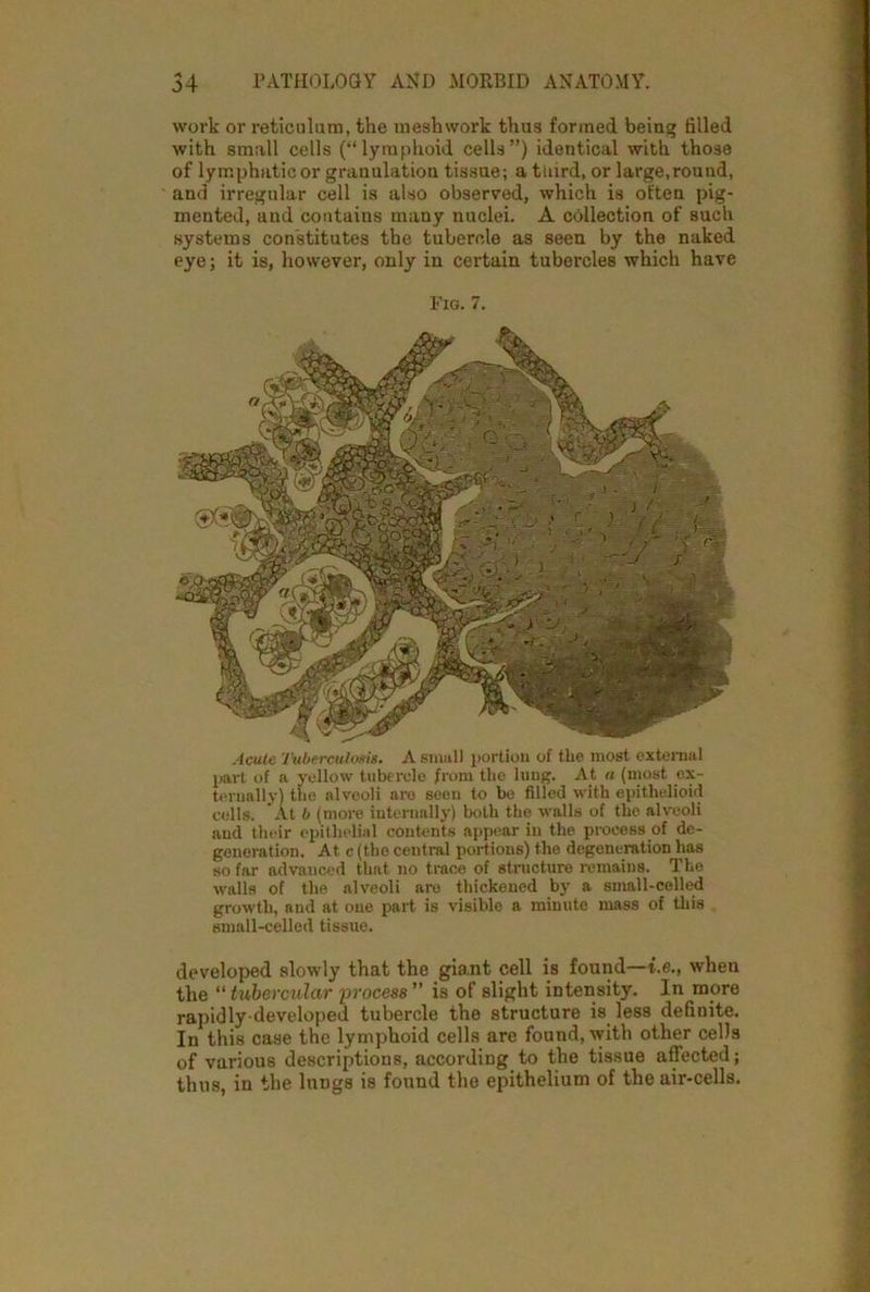 work or reticulum, the meshwork thus formed being filled with small cells (“lymphoid cells”) identical with those of lymphatic or granulation tissue; a tliird, or large,round, and irregular cell is also observed, which is often pig- mented, and contains many nuclei. A collection of such systems constitutes the tubercle as seen by the naked eye; it is, however, only in certain tubercles which have Fig. 7. Acute Tuberculosis. A small portion of the most external part of a yellow tubercle from the lung. At a (most ex- ternally) the alveoli are seen to be filled with epithelioid cells. At b (more internally) both the walls of the alveoli and their epithelial contents appear in the process of de- generation. At c (the central portions) the degeneration has so far advanced that no trace of structure remains. The walls of the alveoli are thickened by a small-celled growth, and at one part is visible a minute mass of this small-celled tissue. developed slowly that the giant cell is found— i.e., when the “ tubercular process ” is of slight intensity. In more rapidly-developed tubercle the structure is less definite. In this case the lymphoid cells are found, with other cells of various descriptions, according to the tissue affected; thus, in the lungs is found the epithelium of the air-cells.